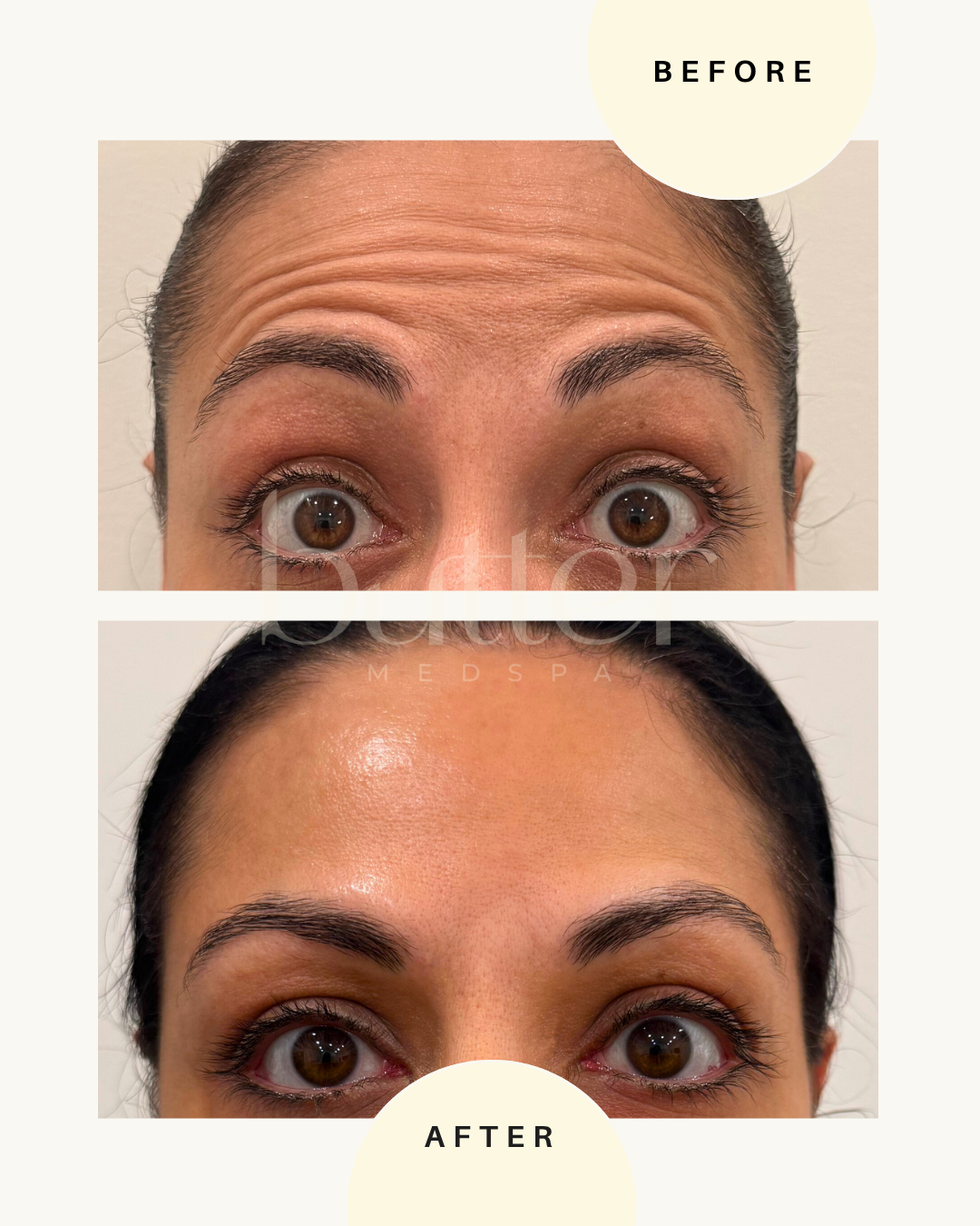 Dysport before and after wrinkle relaxer medspa nj