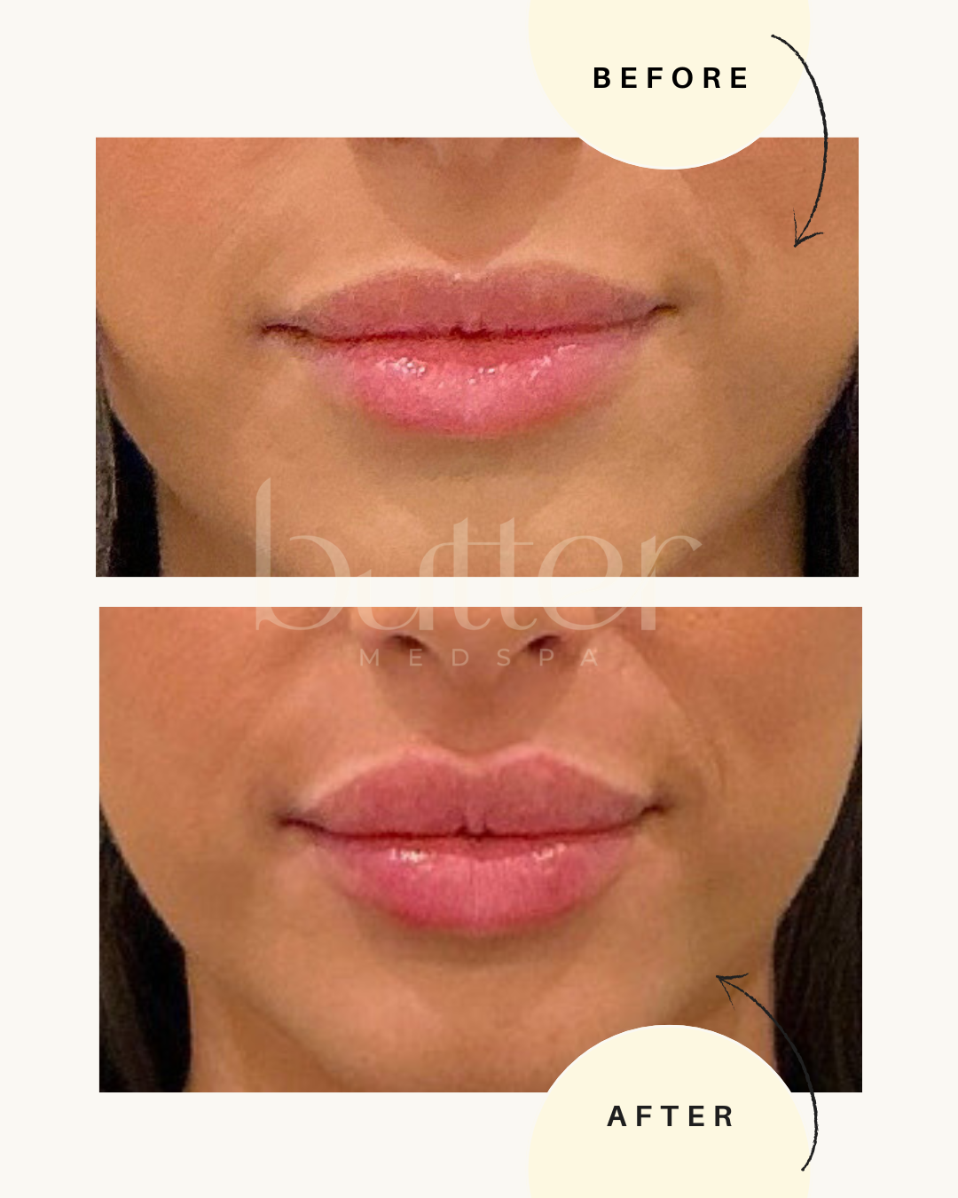 Versa Lip Filler Before and After Englewood NJ