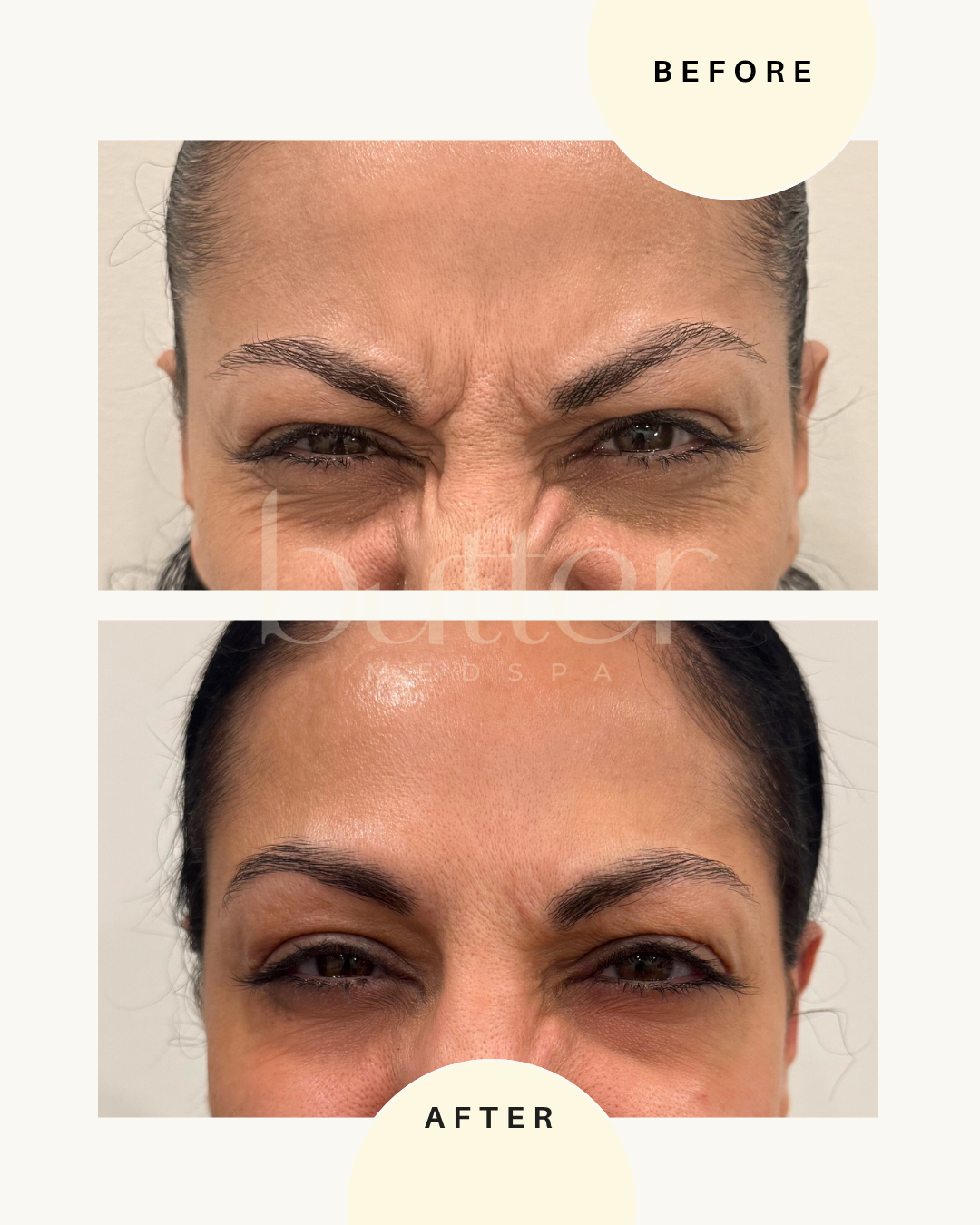 botox before and after photo north jersey