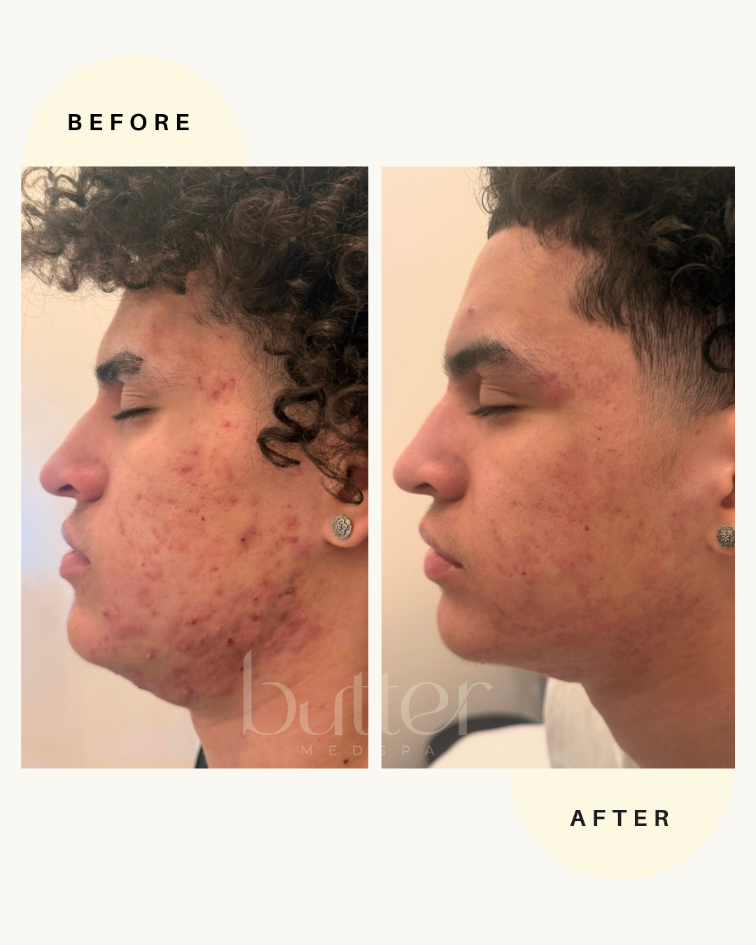 Chemical Peel NJ