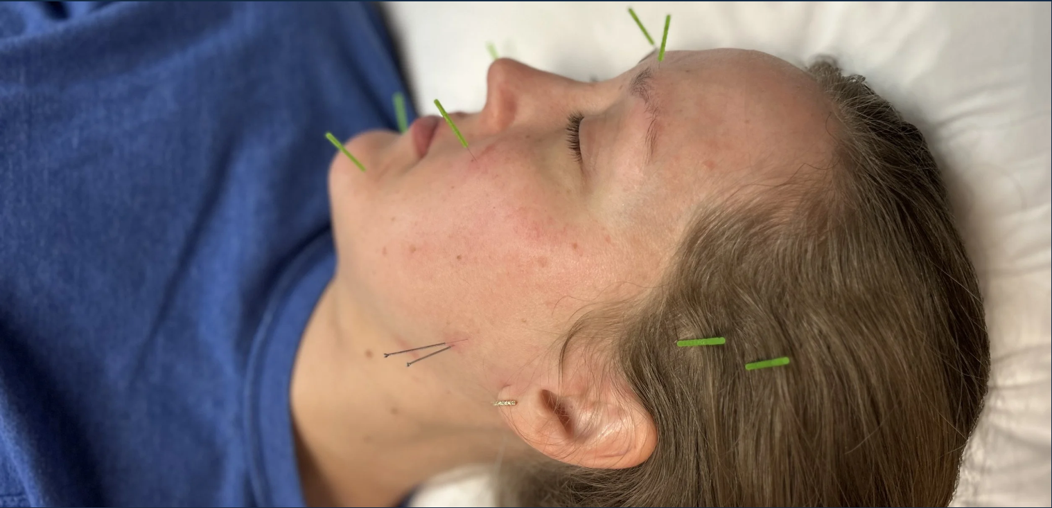 How Dry Needling and Physical Therapy Can Help TMJ Pain