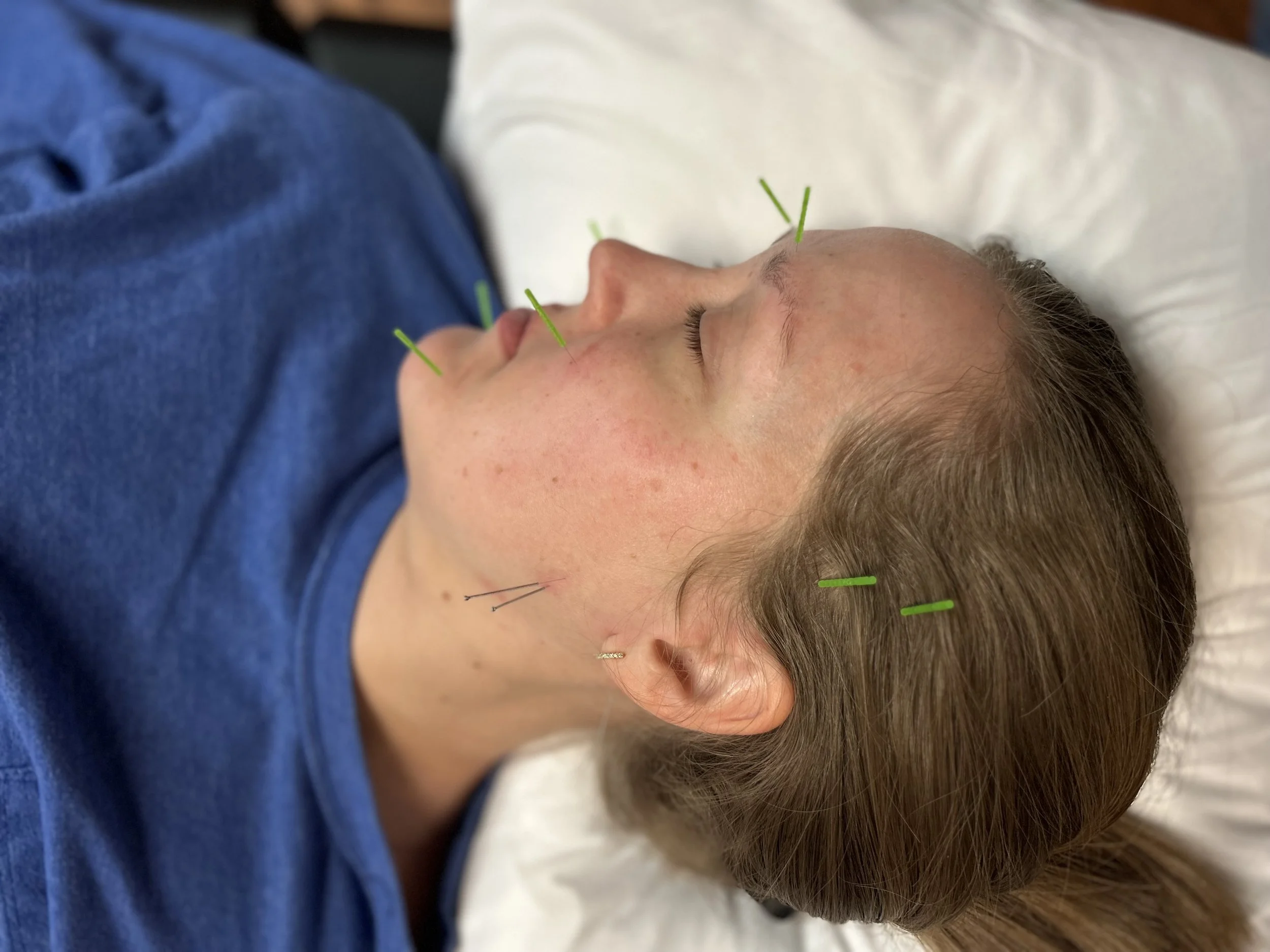 Dr. Natalie Hawkins, PT, DPT, CIDN dry needling a patient with TMJD/jaw pain in Manhattan, Kansas