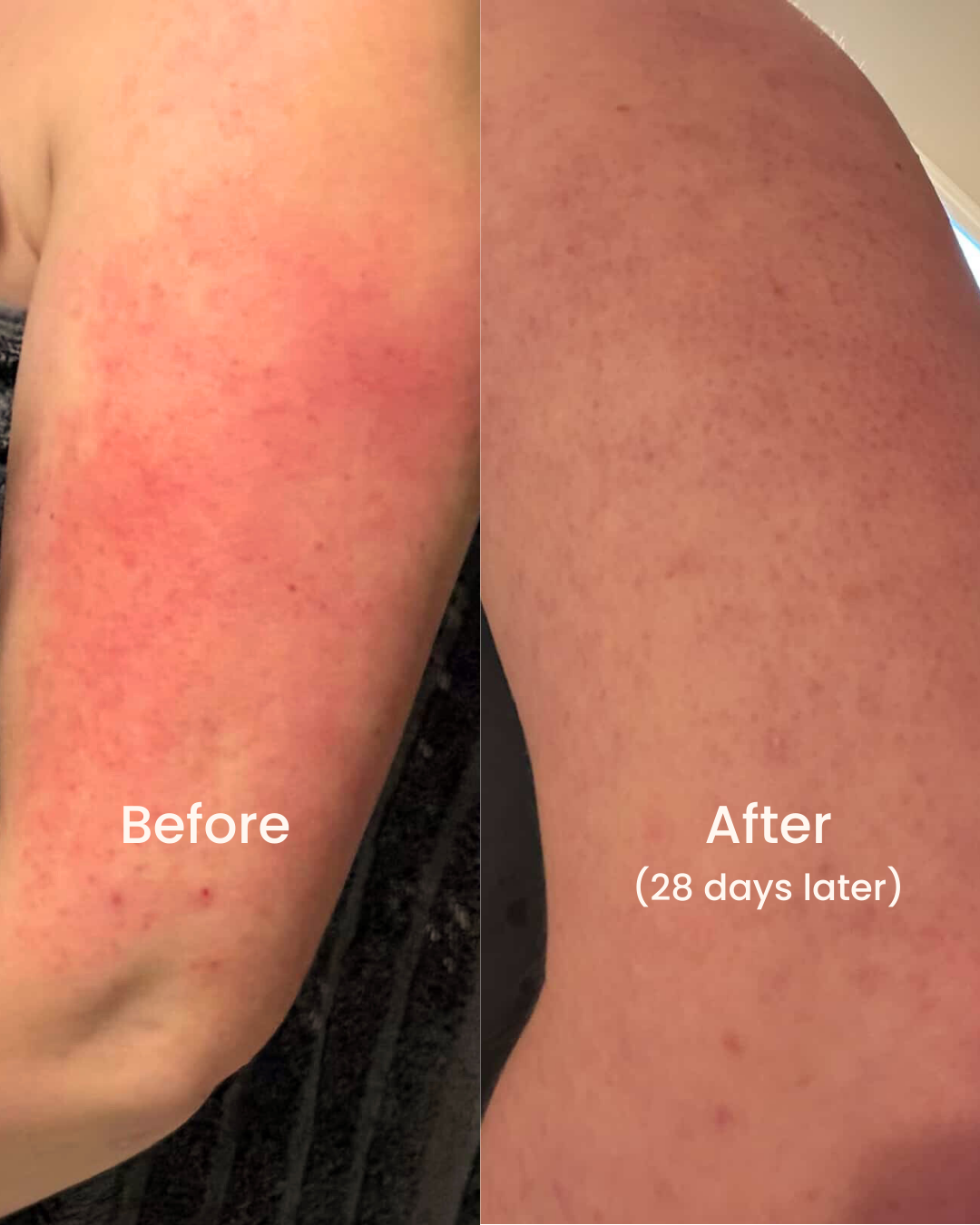 Before and after photos from a customer using our tallow lotion bars for 28 days