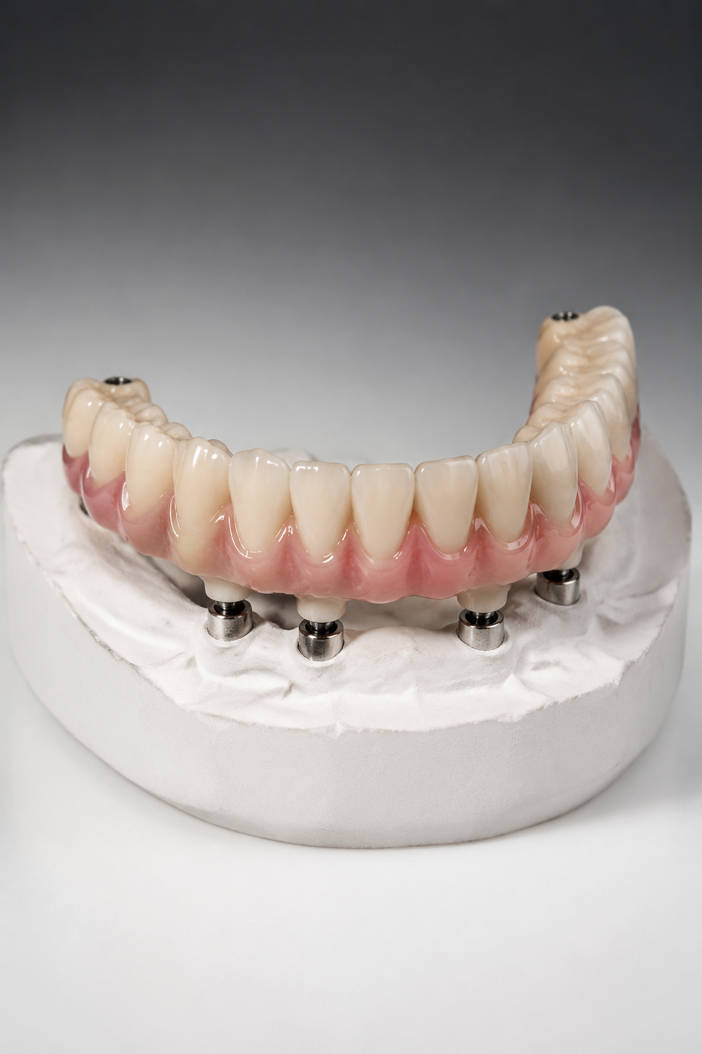 Fixed full-arch implant bridge on a dental laboratory model