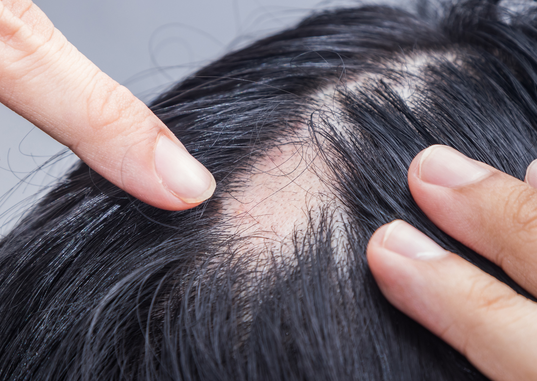 What Is Alopecia Areata — And What Can You Do About It?