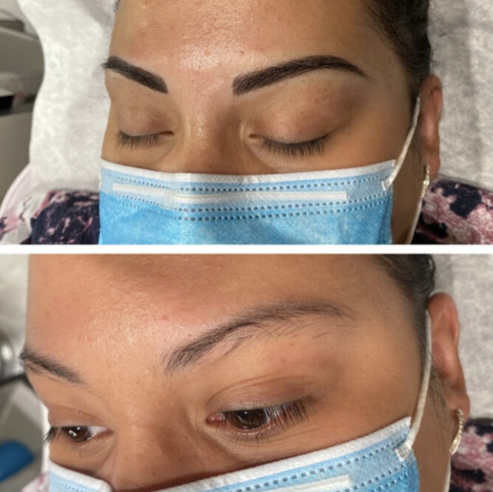 3Der_EyebrowPigmentation_BeforeandAfter_.png