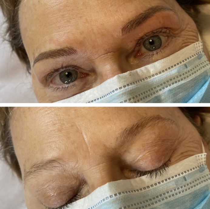 4Der_EyebrowPigmentation_BeforeandAfter_.png