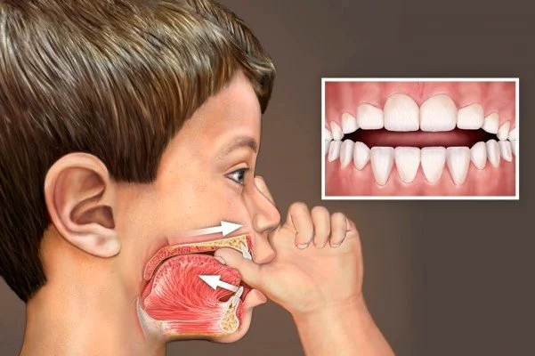 HÁBITOS ORALES | FONOAUDIOLOGÍA