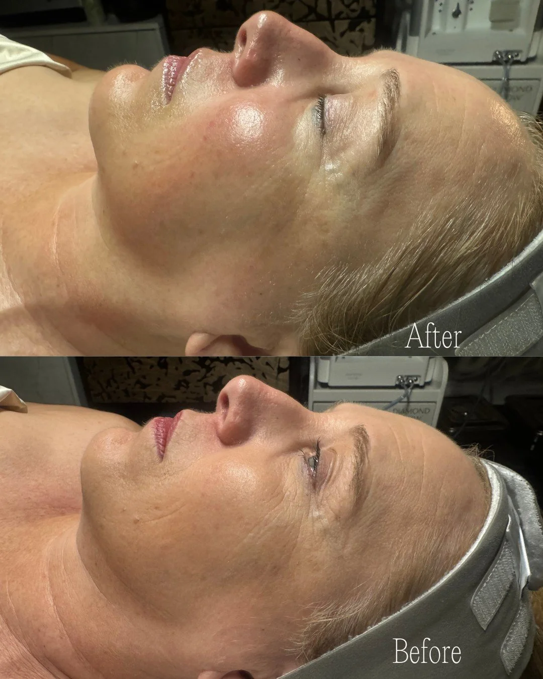 Before ➝ After: Results after one Signature DiamondGlow&reg; Facial

This client&rsquo;s goal was to address the appearance of fine lines and wrinkles while achieving brighter tone and increased hydration&mdash;and these visible results were accompli