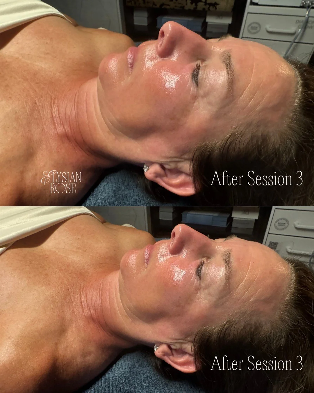 More Dr. Schrammek Green Peel magic. 🌱

The perfect no-downtime treatment - just in time for Valentines Day. 

Book via the link in bio 💙