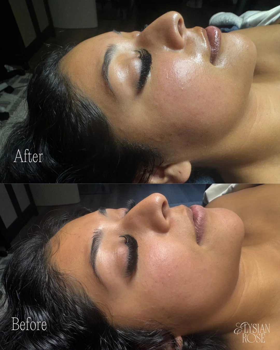 POV: you book a facial that delivers long-term, clinically backed results.

This before and after image features a DiamondGlow&reg; Facial (Silver Experience) with a Vitamin C Serum infusion, paired with a hands-on Manual Lymphatic Drainage add-on fo