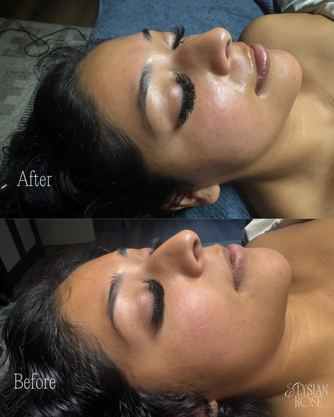 POV: You booked the DiamondGlow&reg; Facial. 💕

This client&rsquo;s treatment featured the SkinMedica&reg; Vitamin C Pro-Infusion Serum, paired with HydroPeptide finishing products to restore hydration and radiance.

If summer sun has your skin look