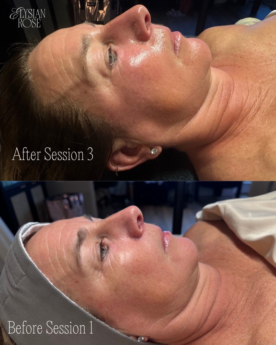 It&rsquo;s finally peel season! 🍂✨

Here&rsquo;s a before + after following a series of three Dr. Schrammek GREEN PEEL&reg; treatments using the Energy customization.

At Elysian Rose, we offer both GREEN PEEL&reg; herbal treatments and traditional 