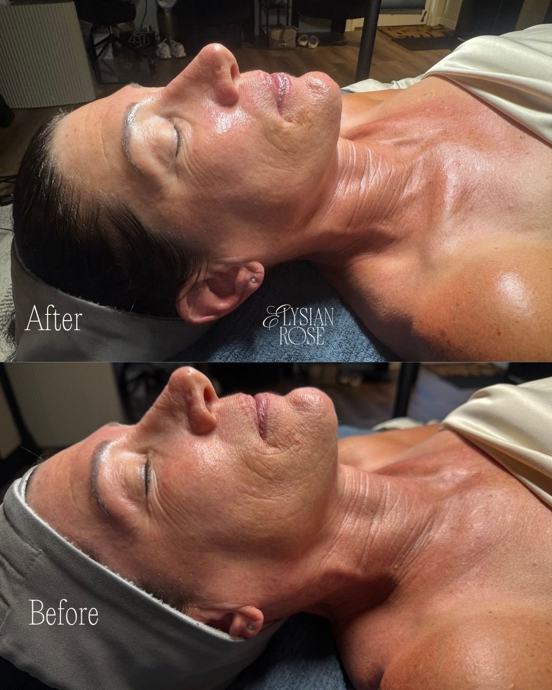 Before + after one DiamondGlow&reg; Even &amp; Correct treatment. ✨

Customized to target pigmentation and uneven tone while leaving the skin smoother, brighter, and more hydrated.

Experience DiamondGlow&reg; at Elysian Rose in Encinitas. Book via t