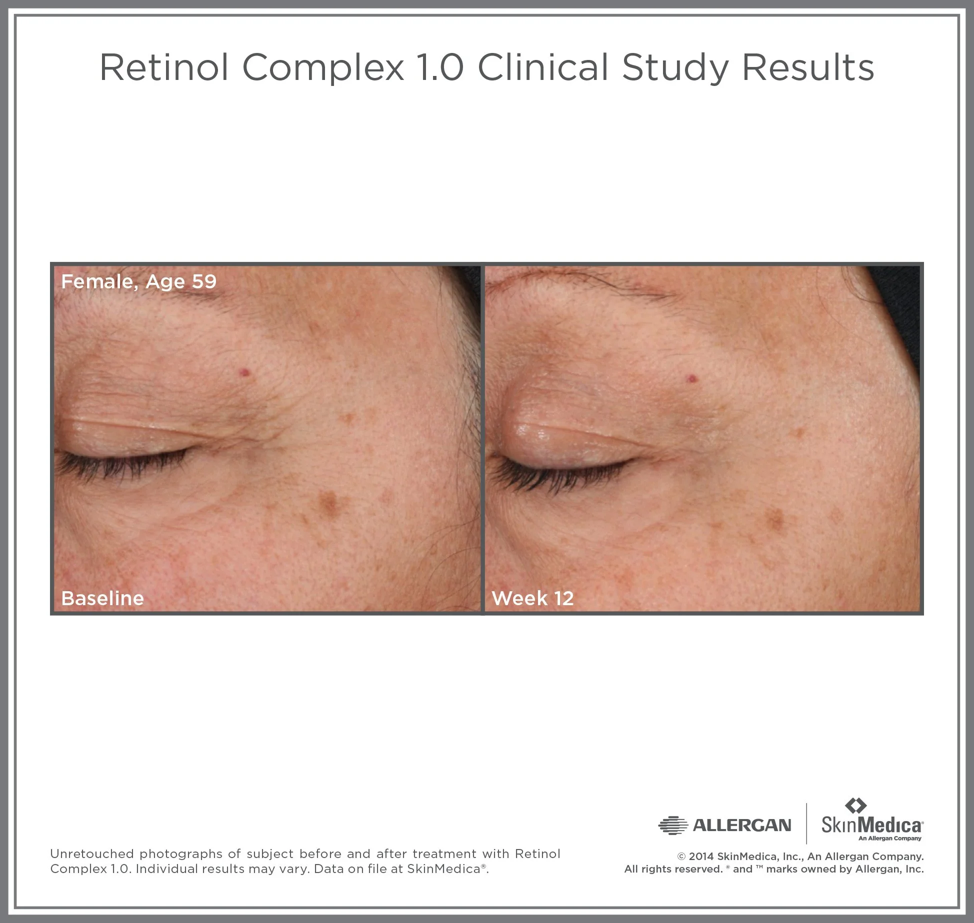 Retinol_1.0_CS_Female_Age59.jpg
