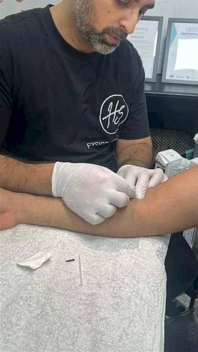 Fysiotherapeut voert DryNeedling behandeling uit op arm op hygiënische wijze