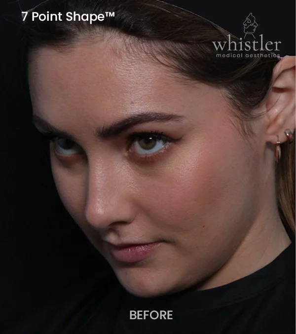 ✨ Before & After ✨
A defined jawline is one of those features that quietly transforms the entire face. It’s subtle, but the impact is profound—bringing shape, balance, and confidence to the profile.
Through the 7 Point Shape approac