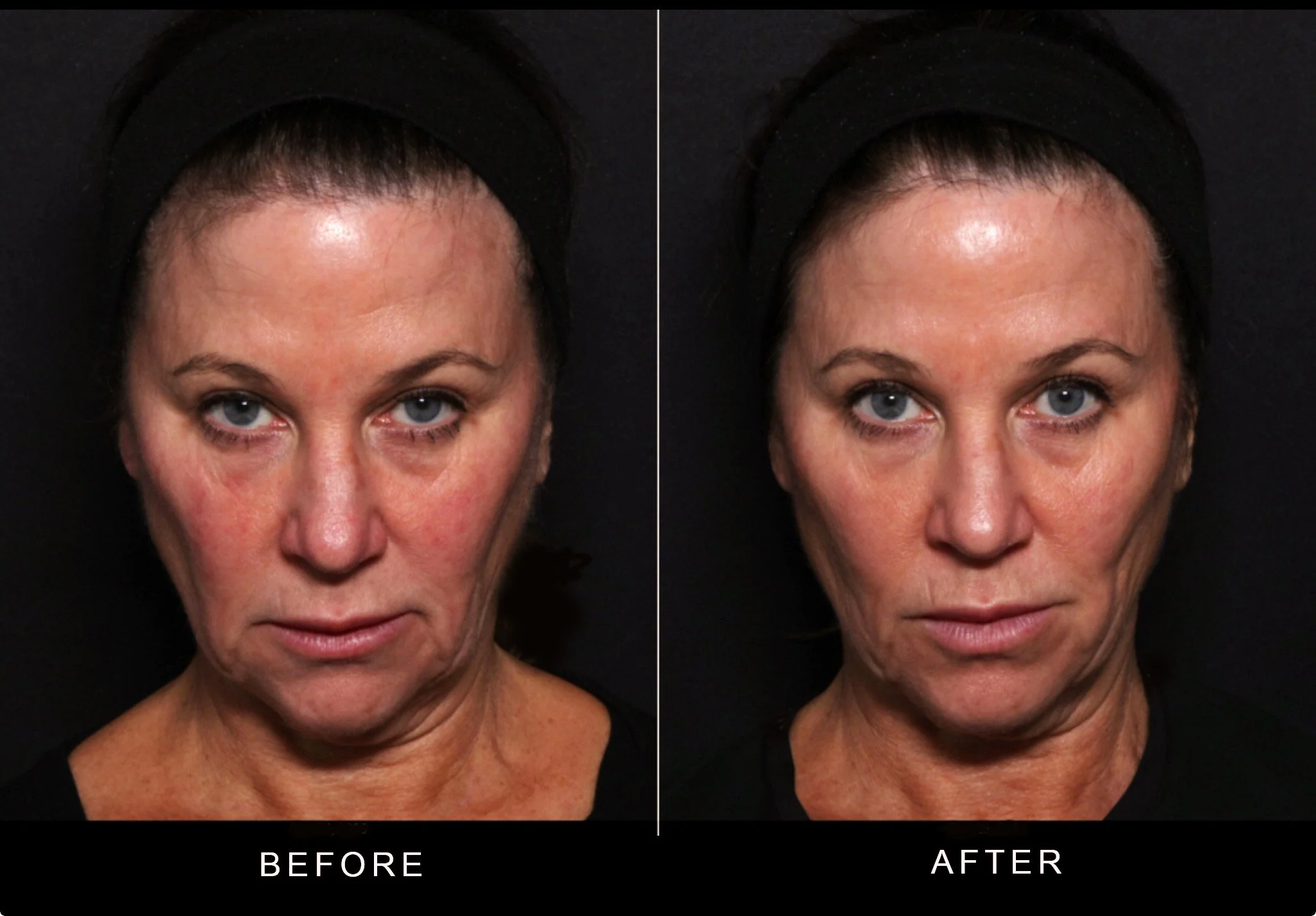 Threads Outcome at Whistler Medical Aesthetics 