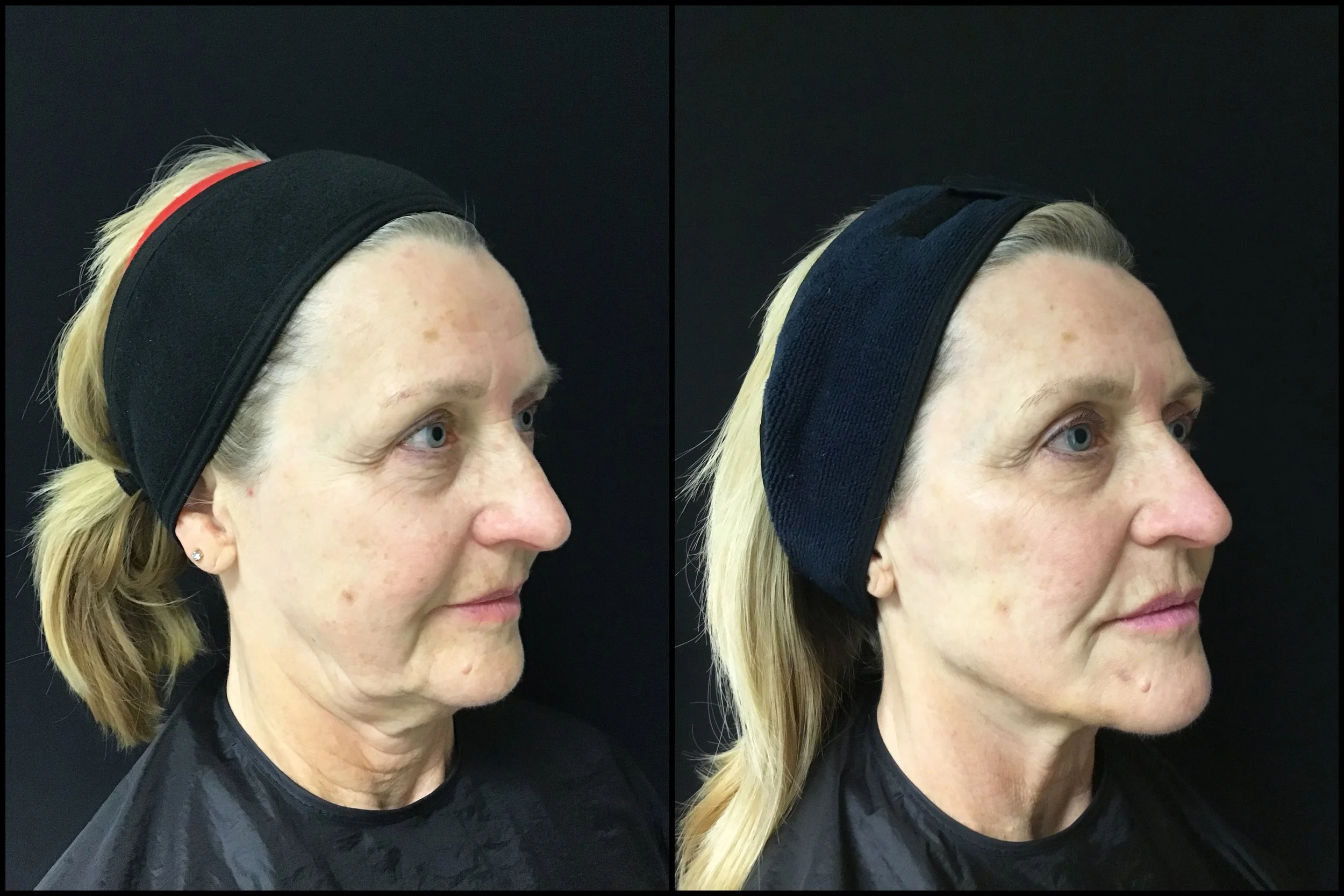 Full Face treatment and Contouring