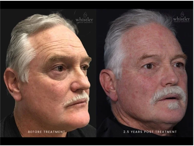Male- Full Face Treatment