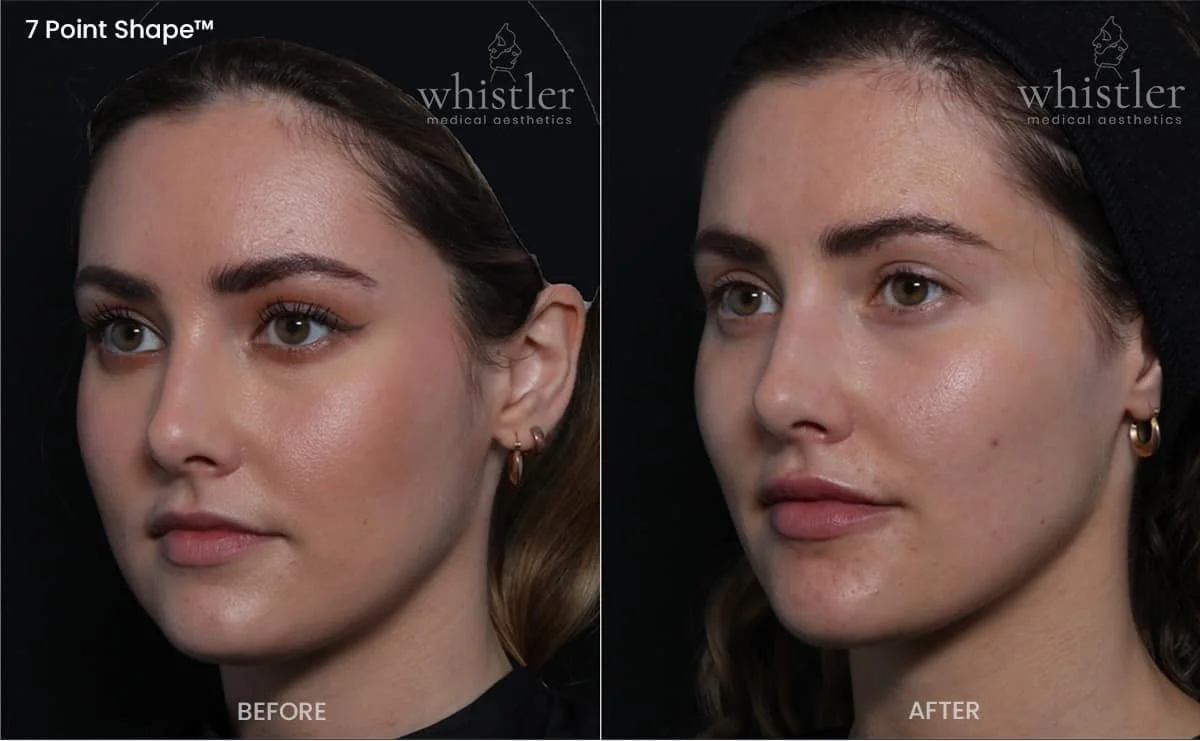 Side-by-side comparison of a woman's face showing before and after a 7 Point Shape treatment, showing the defintiion and contour of the womans jawline, and sublty enhanding the cheeks, supporting loss of volume under the eye