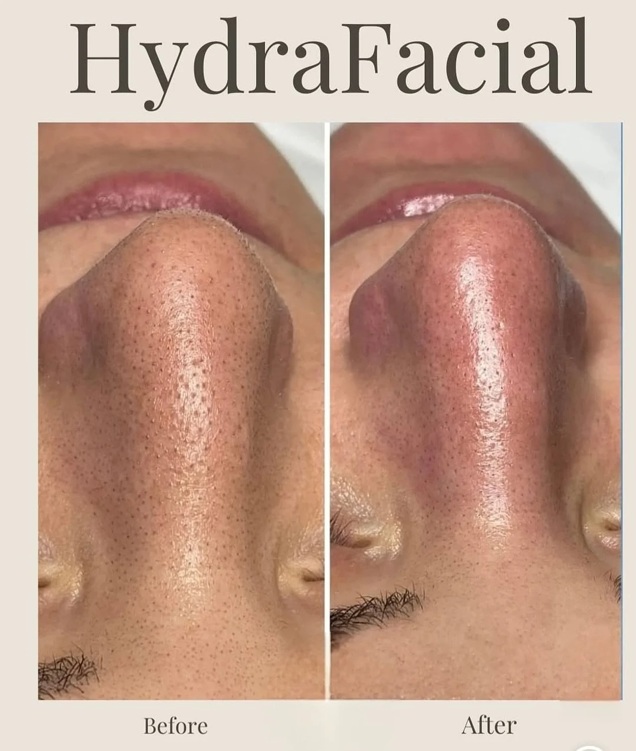 🌟 Hydrodermabrasion Glow-Up 🌿

Get ready for the ultimate facial! 
Bookings opening soon 🙏

&bull; ✨ Improved Texture &amp; Tone: Smoother, radiant skin!
&bull; 💧 Deep Hydration: Plumps &amp; nourishes instantly!
&bull; 🧽 Pore Cleansing: Bye-bye