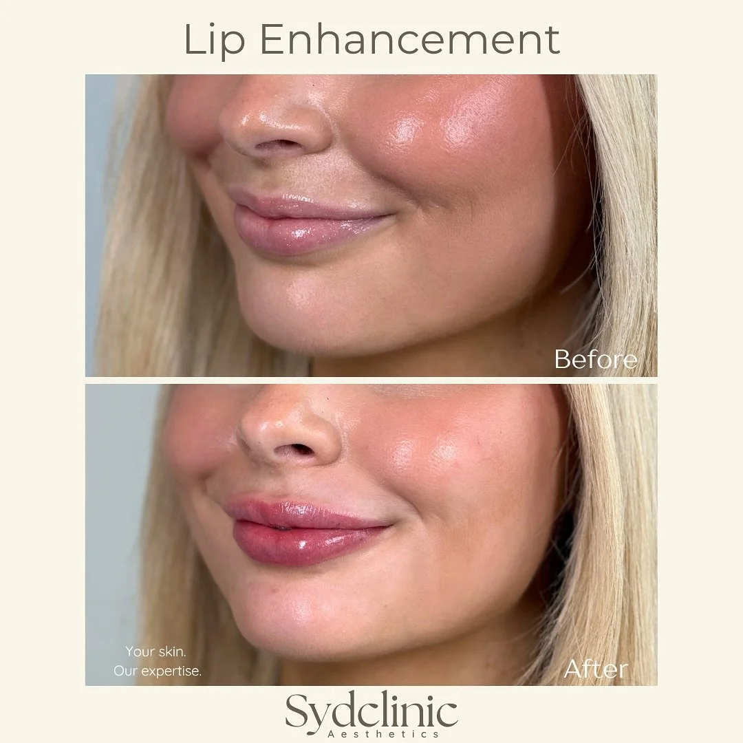 This lip enhancement focuses on subtle volume and gentle definition to elevate her natural lip shape while keeping everything soft and balanced.

At Sydclinic, every result is tailored to your unique features.

Considering a lip enhancement? 

Tap li