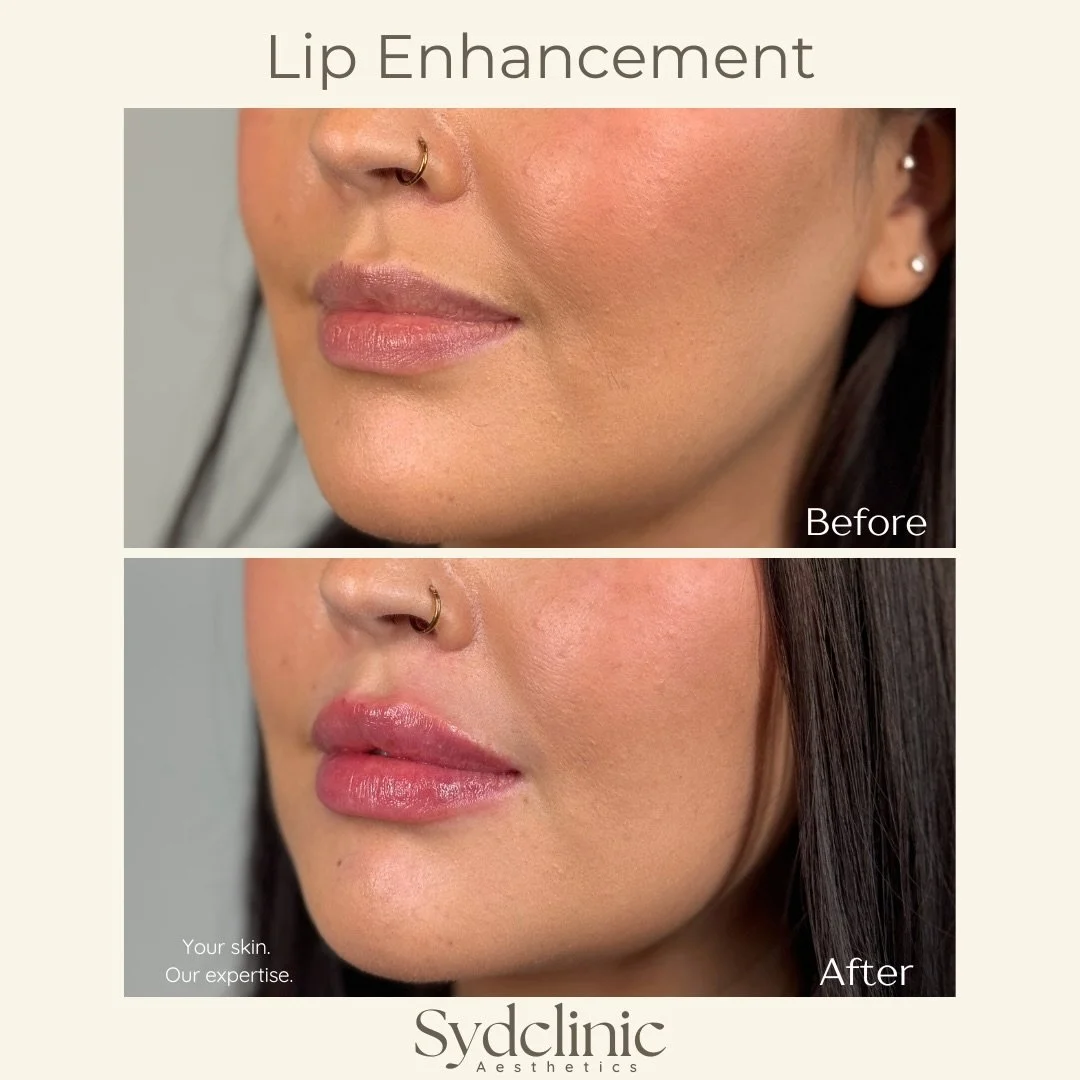 Defined, natural lip enhancement 💉

With careful, precise technique, we enhance your lip shape, balance symmetry, and boost hydration. 

The goal: soft, balanced results that look like you, just refined.

Curious about Lip Enhancements? Book a compl