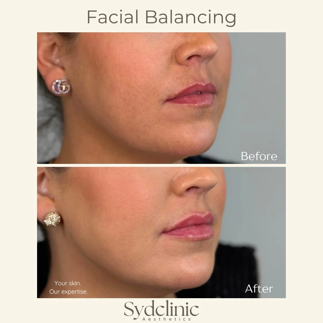 Facial balancing is never one-size-fits-all.

Each full facial balancing treatment is customized to address multiple areas of concern, enhancing harmony and natural-looking results.

Swipe to see the breakdown of this tailored treatment plan.

Intere
