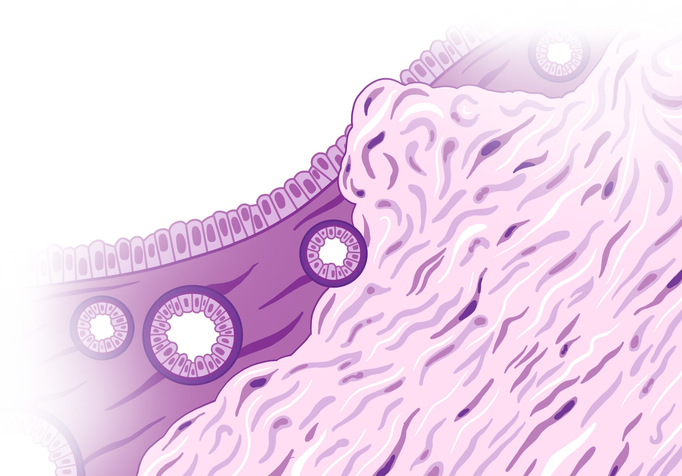 illustration of schematic for invasive tumor