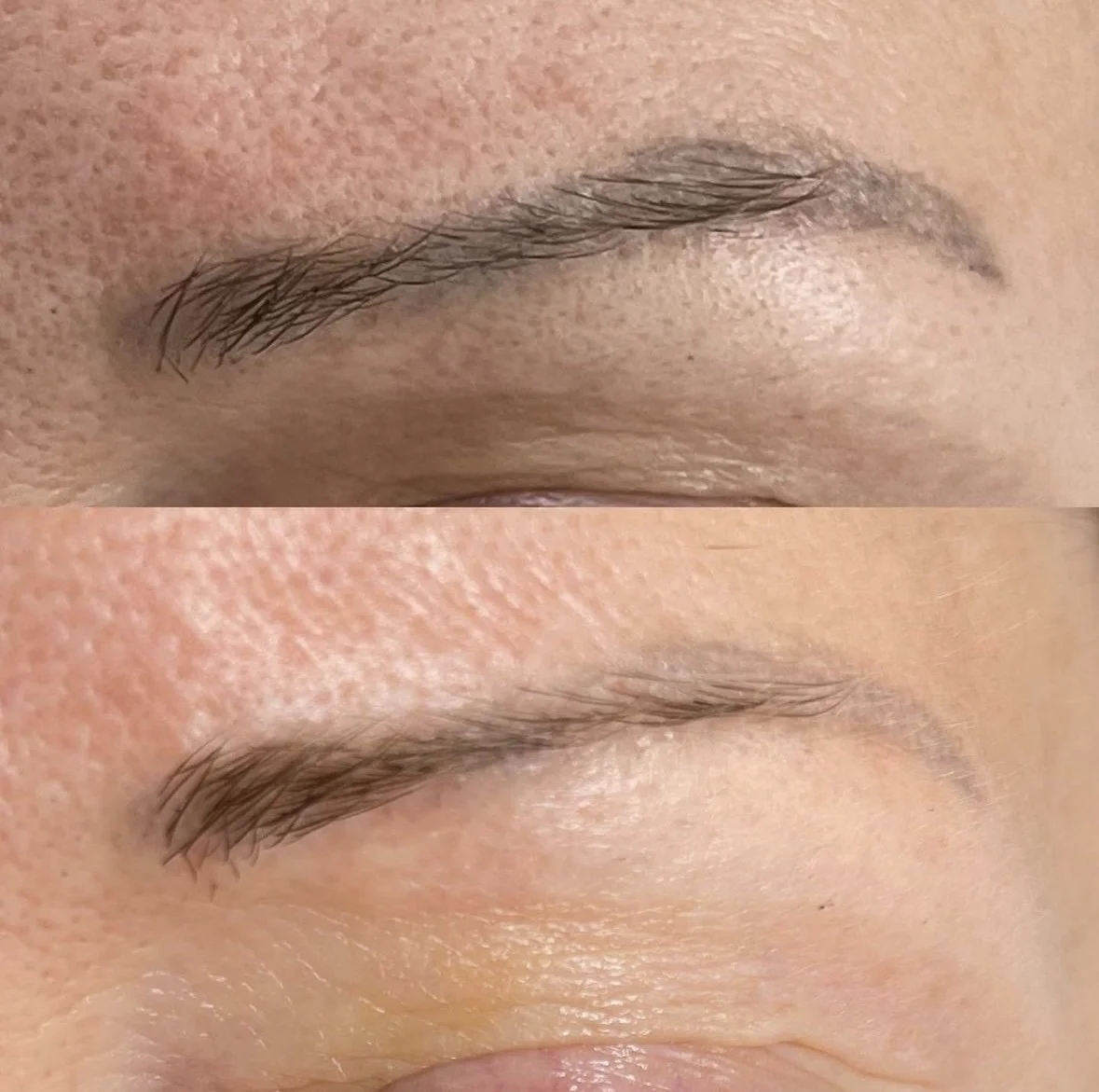 saline tattoo removal