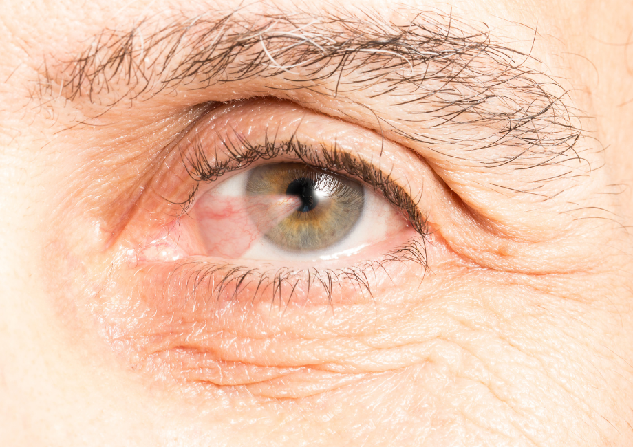 Ojo con pterigión nasal