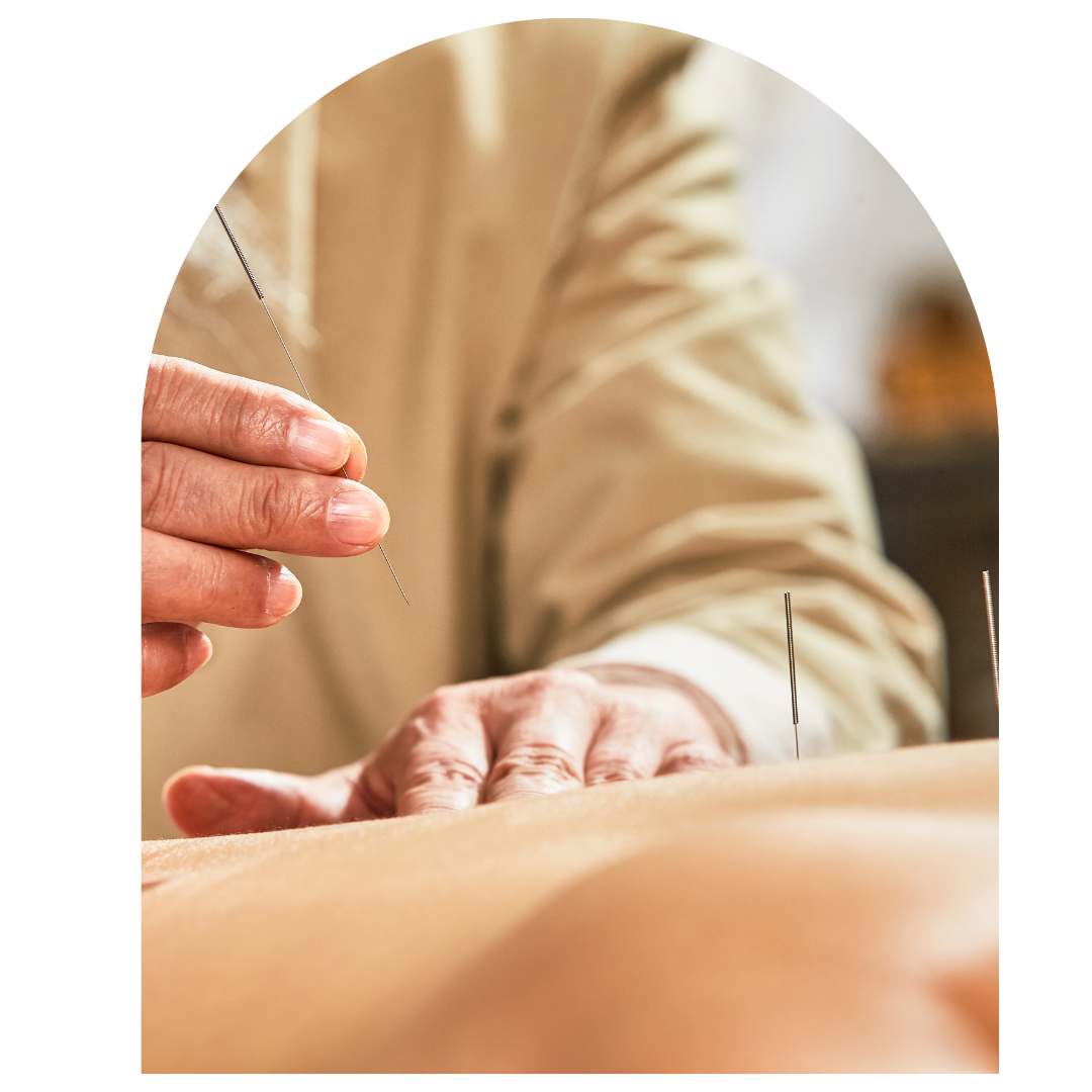 Close-up of a practitioner’s hands gently inserting fine acupuncture needles into a patient’s back during a traditional Chinese medicine treatment session
