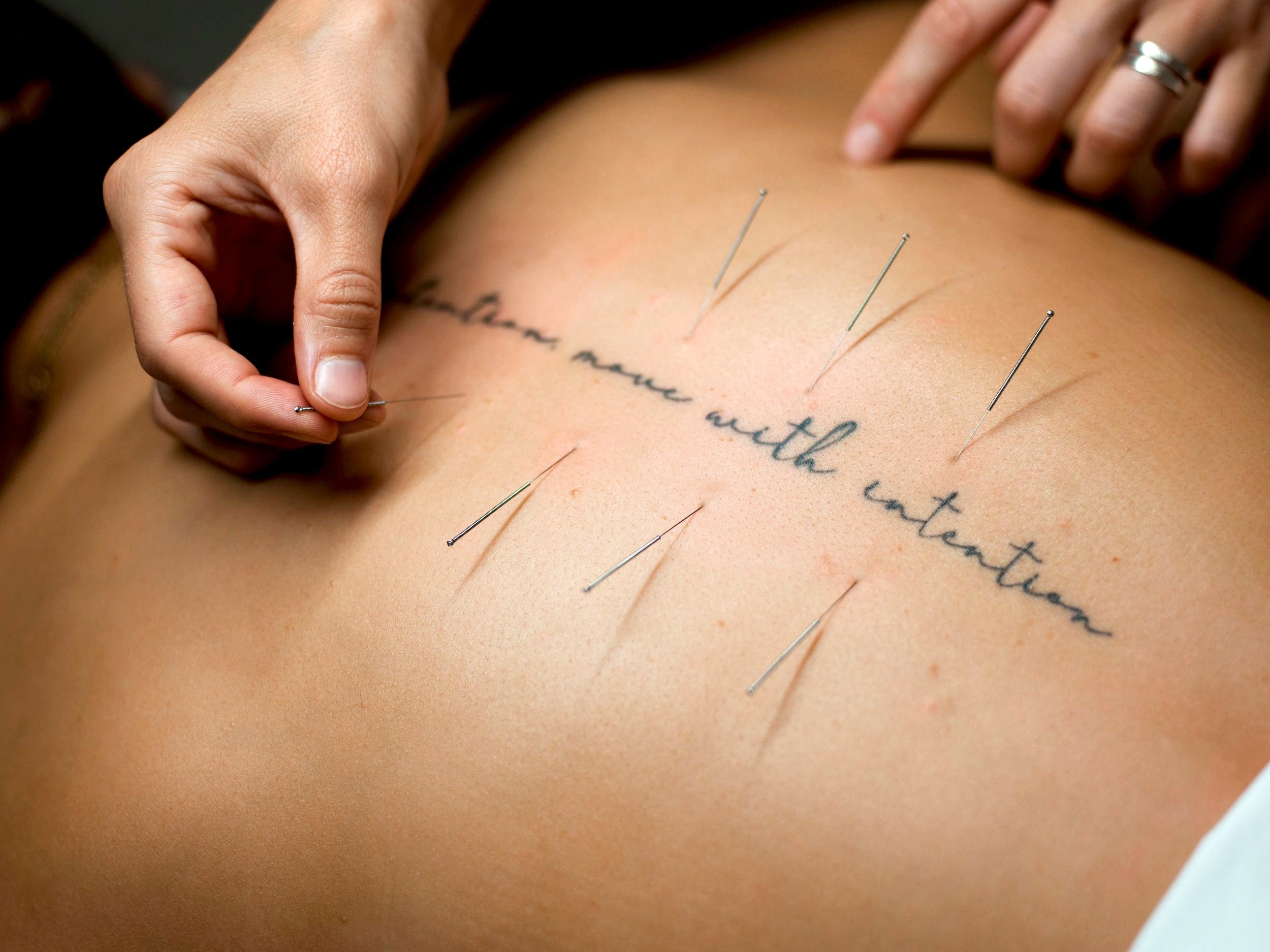 Acupuncture for PMDD: Can It Help Severe Premenstrual Mood Symptoms?
