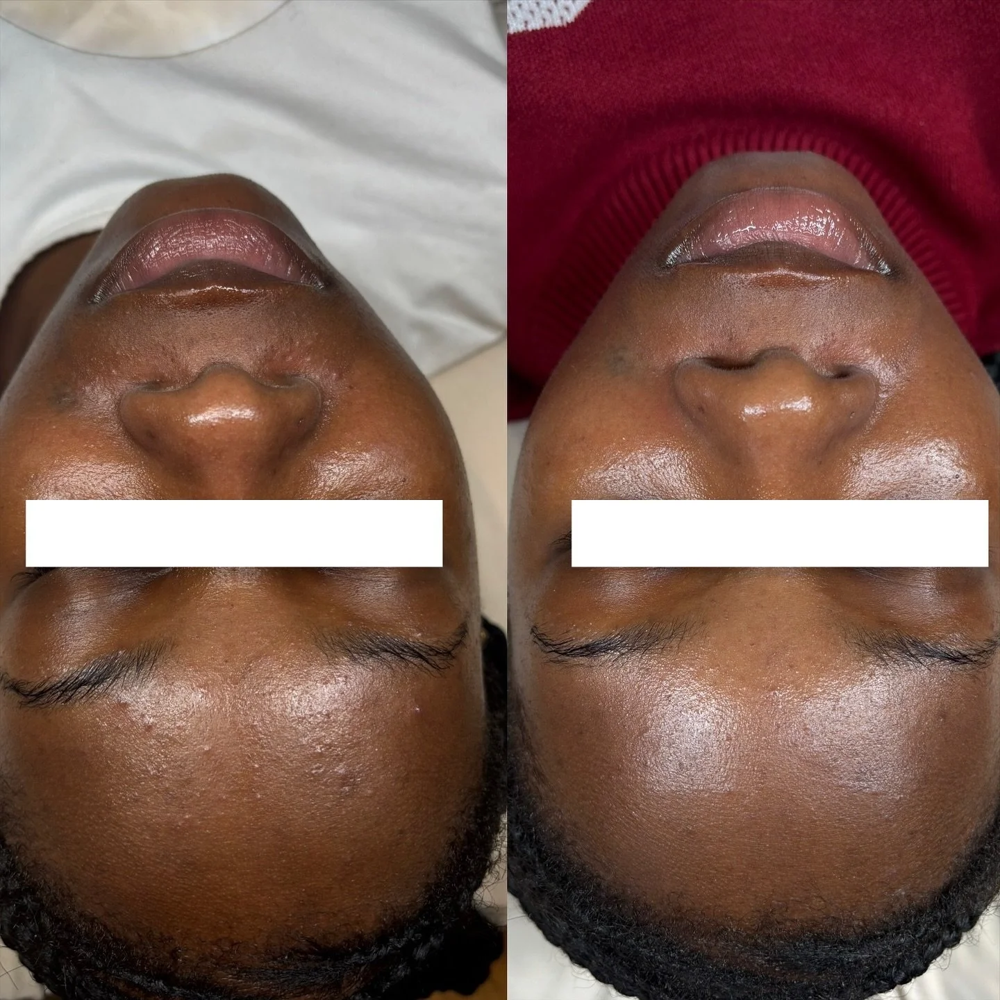 One month difference 🤏🏽
Only one treatment with me &amp; a curated skincare routine 👏🏽

Today was her first chemical peel &amp; I&rsquo;m so excited to see her skin improve more! 😍

She upgraded &amp; is now a Plus Member in my Membership Progra
