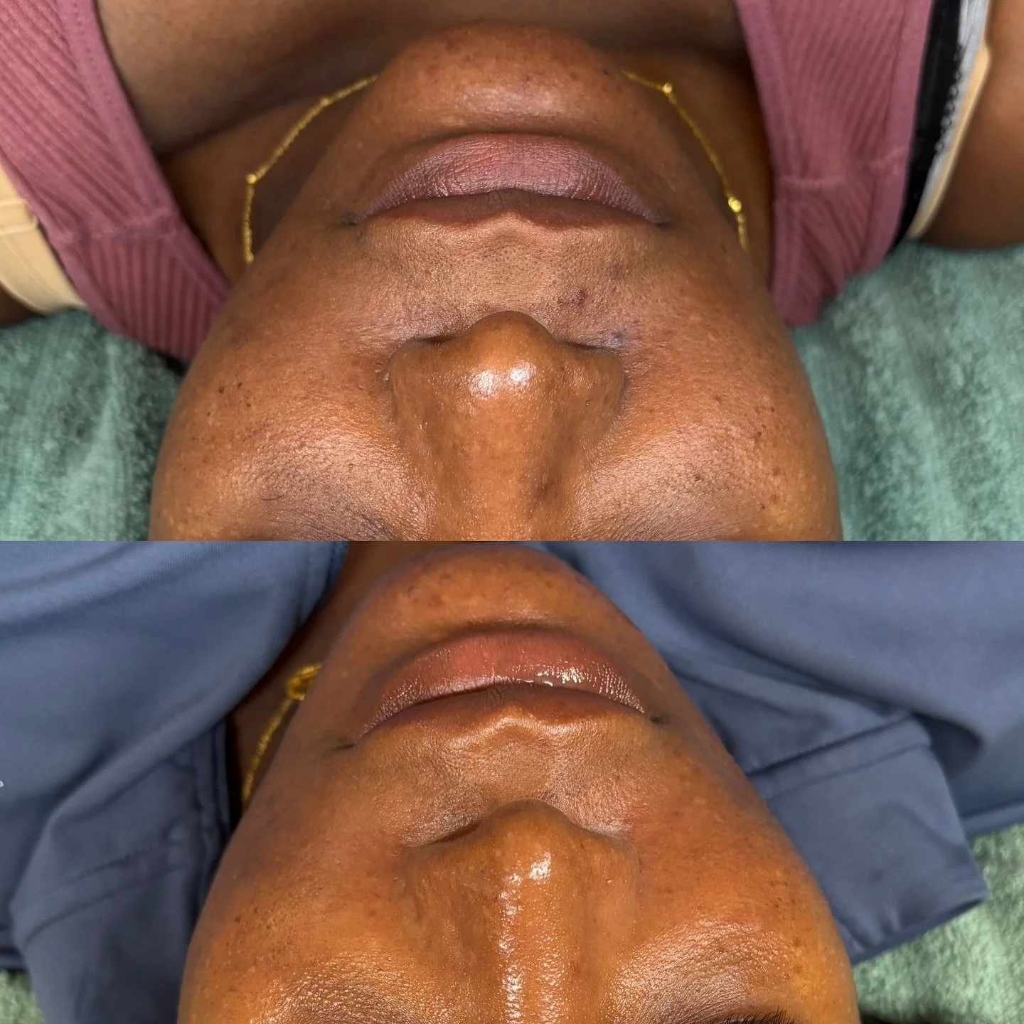 From her first appointment in May to Today🤩

A mix of chemical peel treatments + consistent home care *chefs kiss* 

Non-Member Chemical Peels: $150
Members: $110

Click the link in my bio to learn more about my membership programs to help you save 