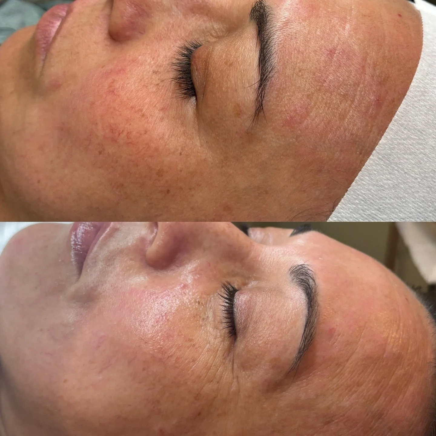 Healing skin, one facial at a time 💖

When I first did her facial a few months ago, she had eczema flare up&rsquo;s that caused her skin to itch &amp; burn. She&rsquo;s been using the products I&rsquo;ve recommended and her skin has healed so much s