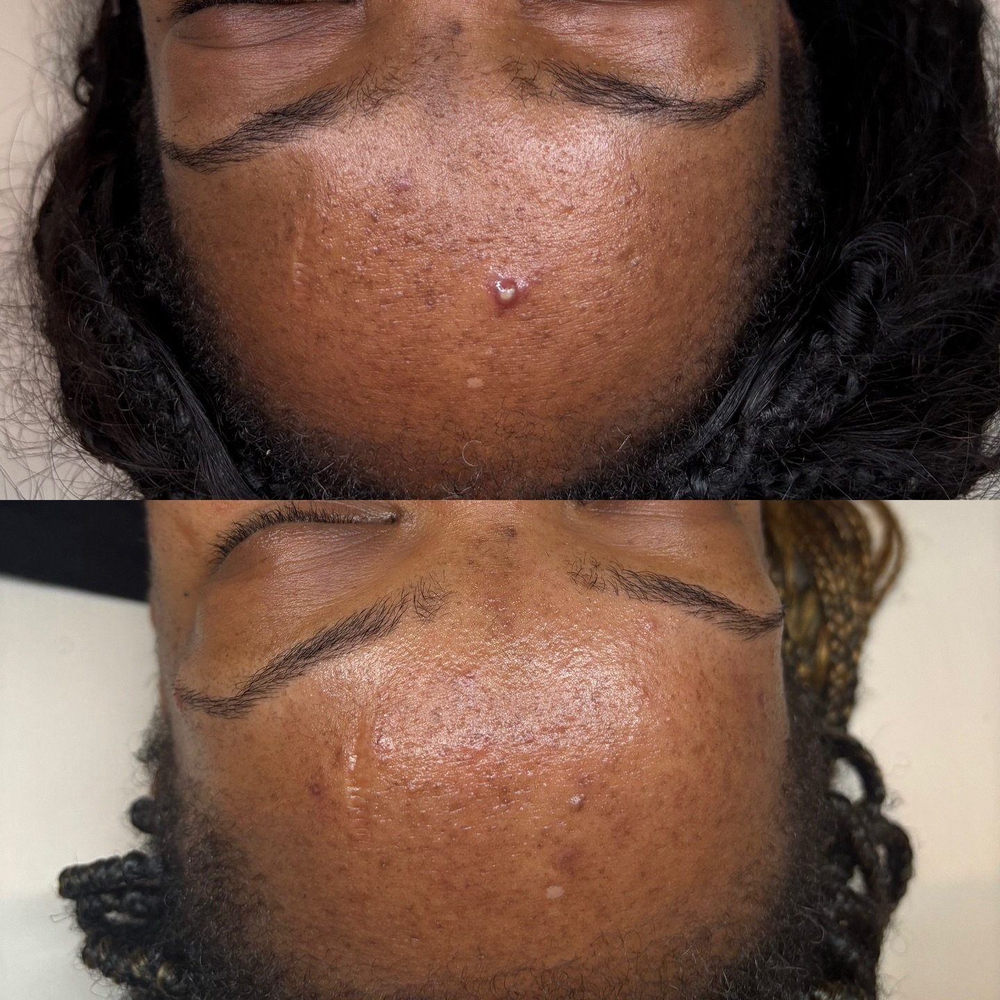 BLACK FRIDAY CHEMICAL PEEL SALE ‼️

Perfect for all skin types&mdash; see results as little as 1 session! (A minimum of 5 series recommended) No downtime &amp; no peeling! It&rsquo;s the perfect time to buy a gift card or treatment for yourself or so