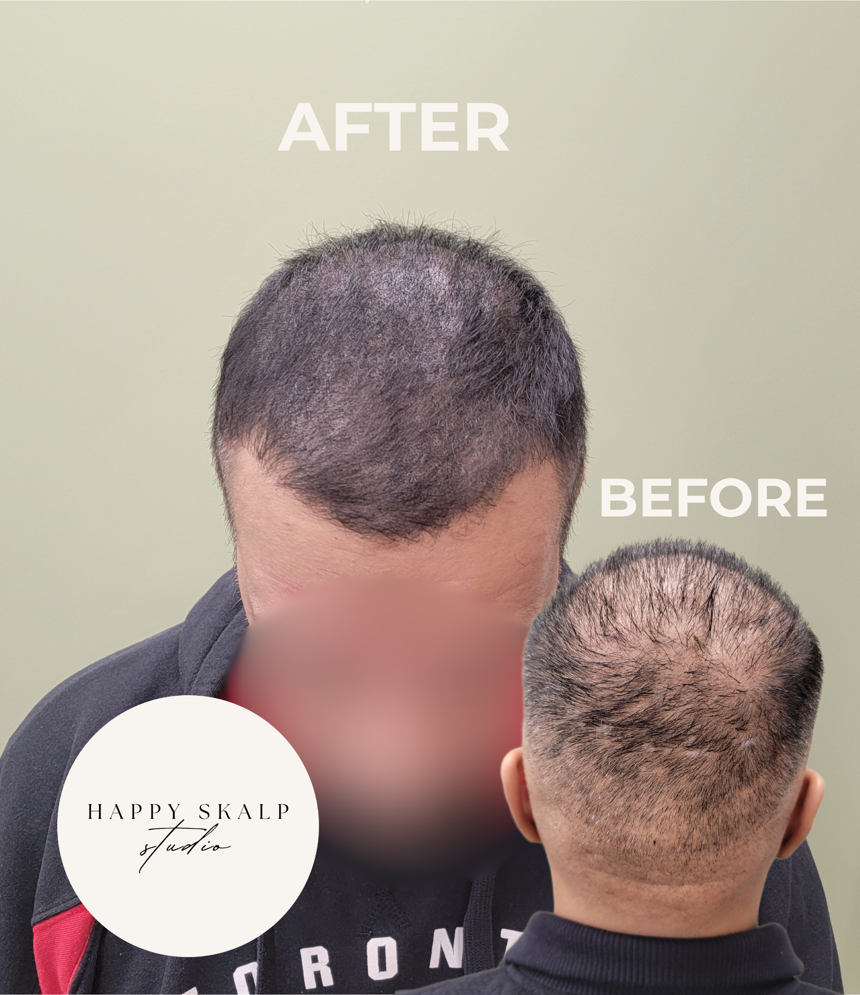 Before and after images of a man's scalp showing scalp micropigmentation success, with the words 'BEFORE' and 'AFTER' overlaid.