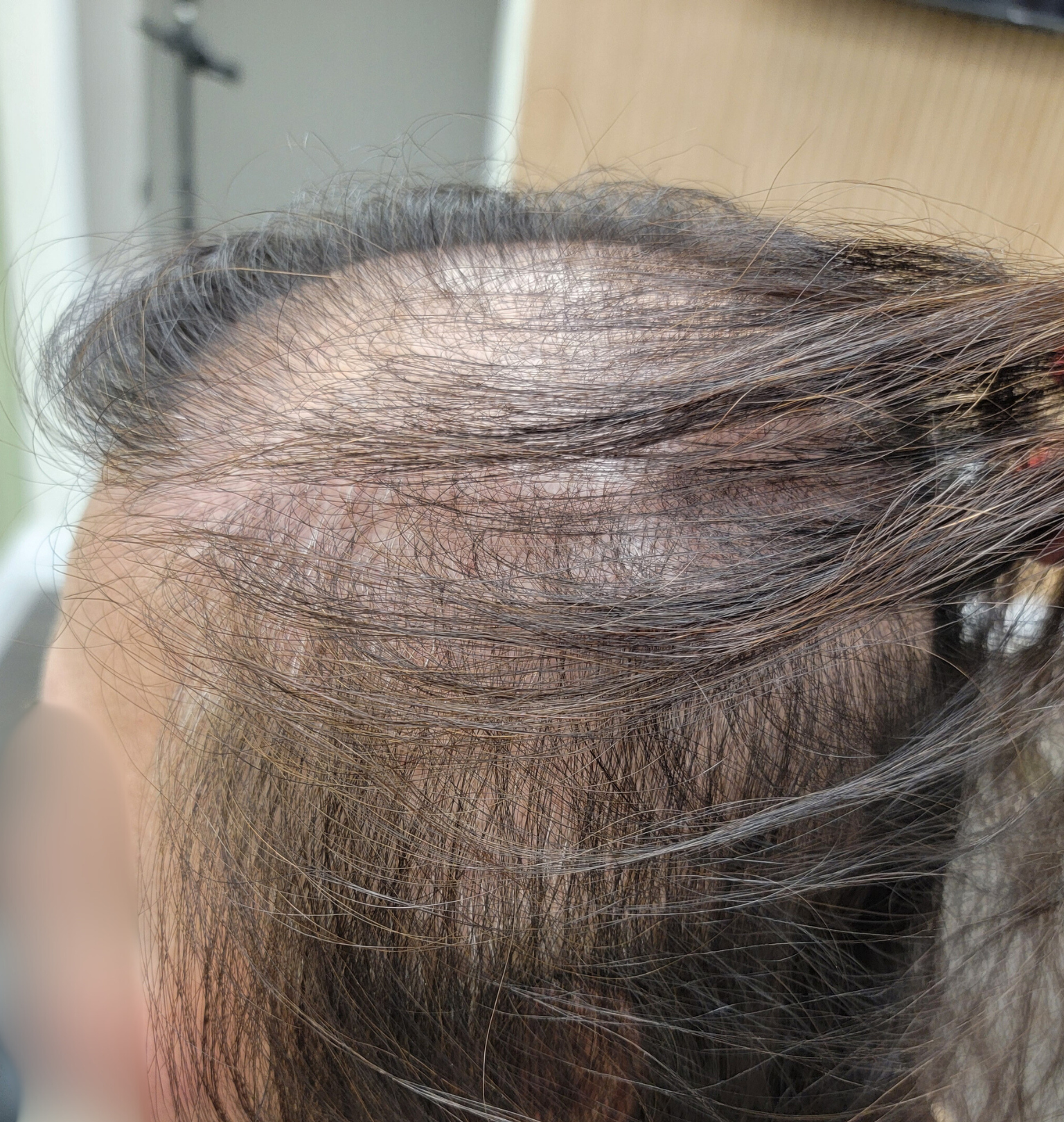 Top view of a person's head with brown hair showing signs of thinning or hair loss along the parting.