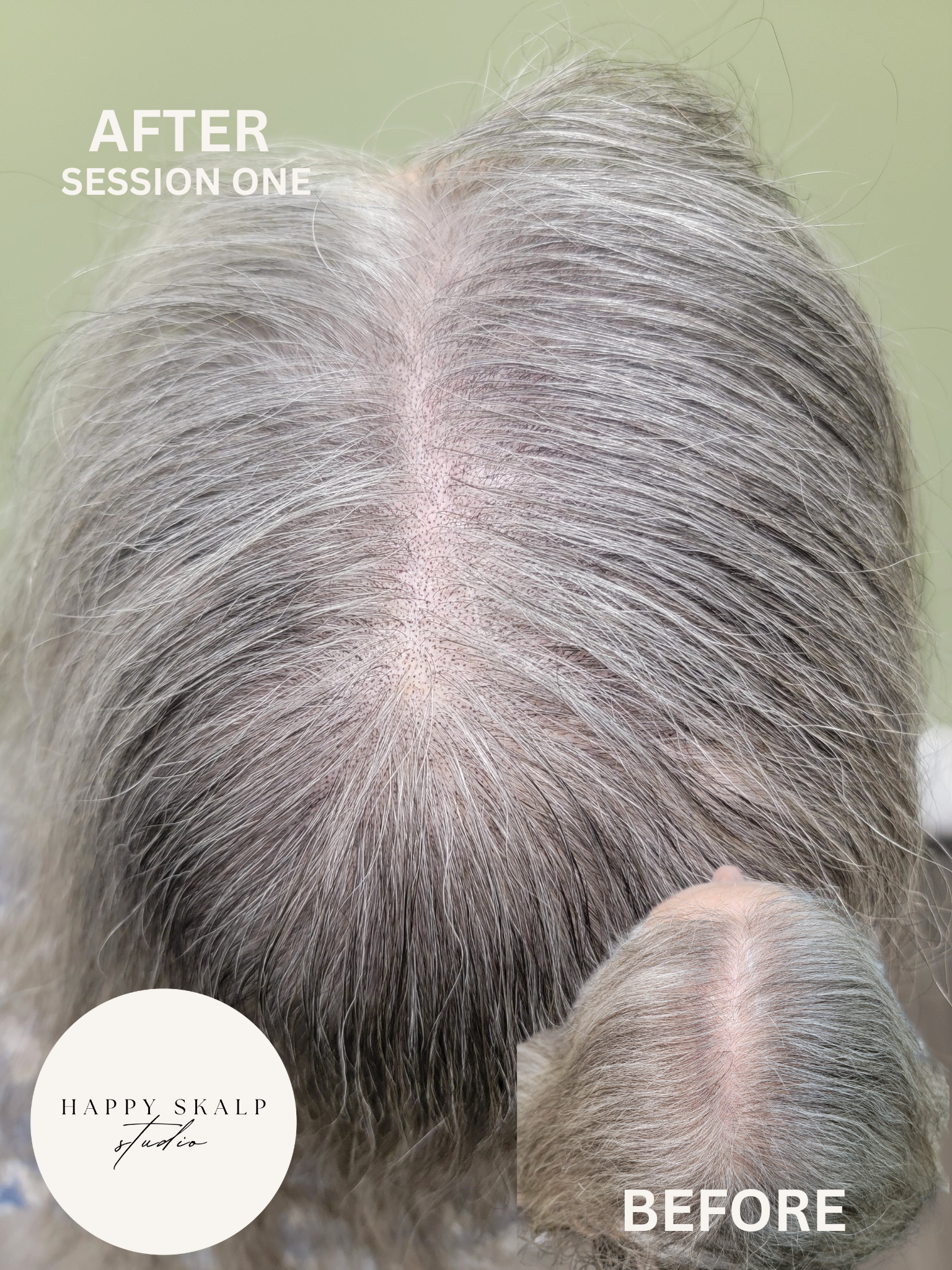 Comparison of a woman's scalp before and after SMP treatment session, showing increased hair density and reduced scalp visibility.