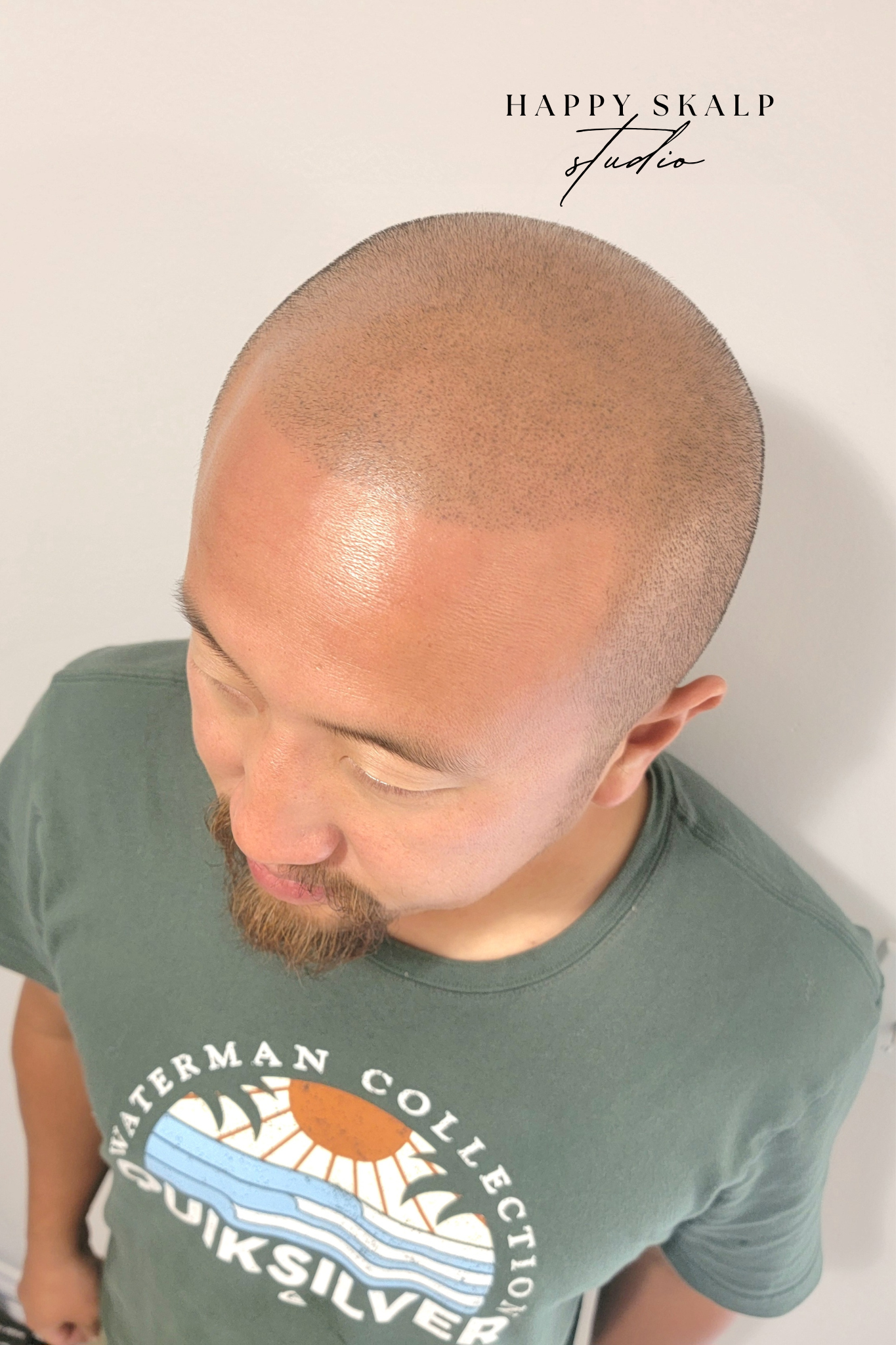 A man with a shaved head look - healed results from scalp micropigmentation. He has a restored hairline and a shaved head look