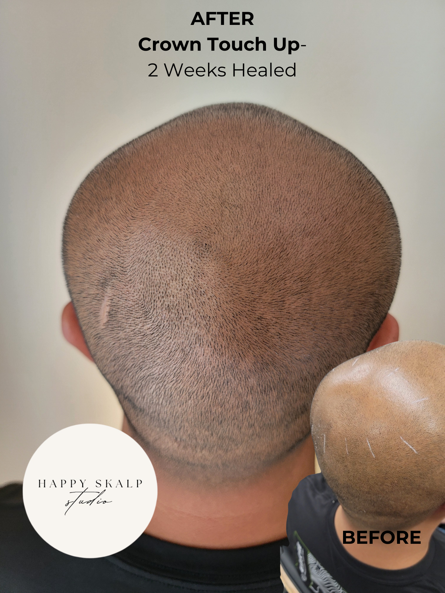 Top view of a shaved man's head, showing a freshly done scalp micropigmentation or tattoo. The small inset image shows the scalp before treatment with visible markings. Text states "AFTER Crown Touch Up- 2 Weeks Healed" and the logo of Happy Skalp Studio.