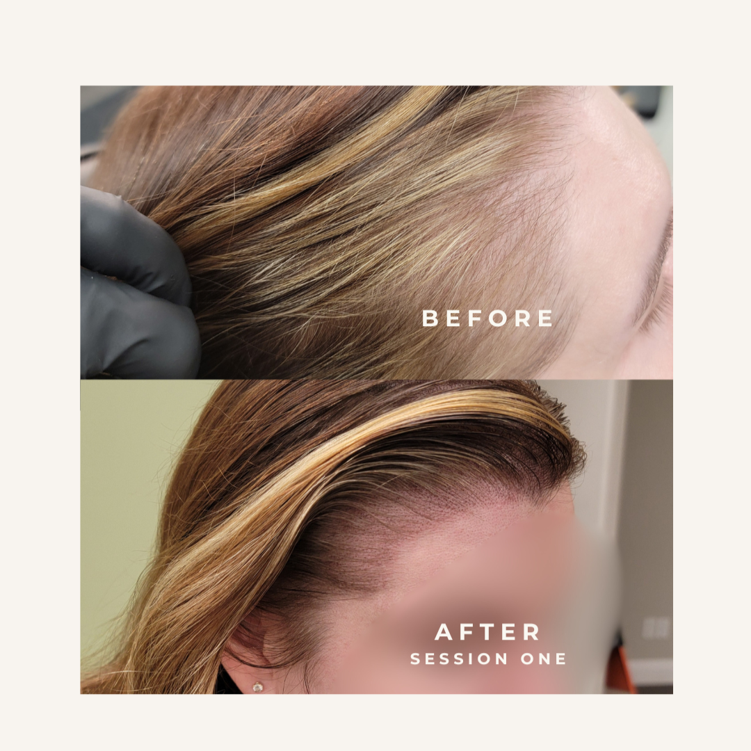 Before and after images showing a woman's hair transformation, with the 'before' image displaying the scalp with natural hair and the 'after' image showing a fuller, styled look after one session of scalp micropigmentation at her temples and hairline