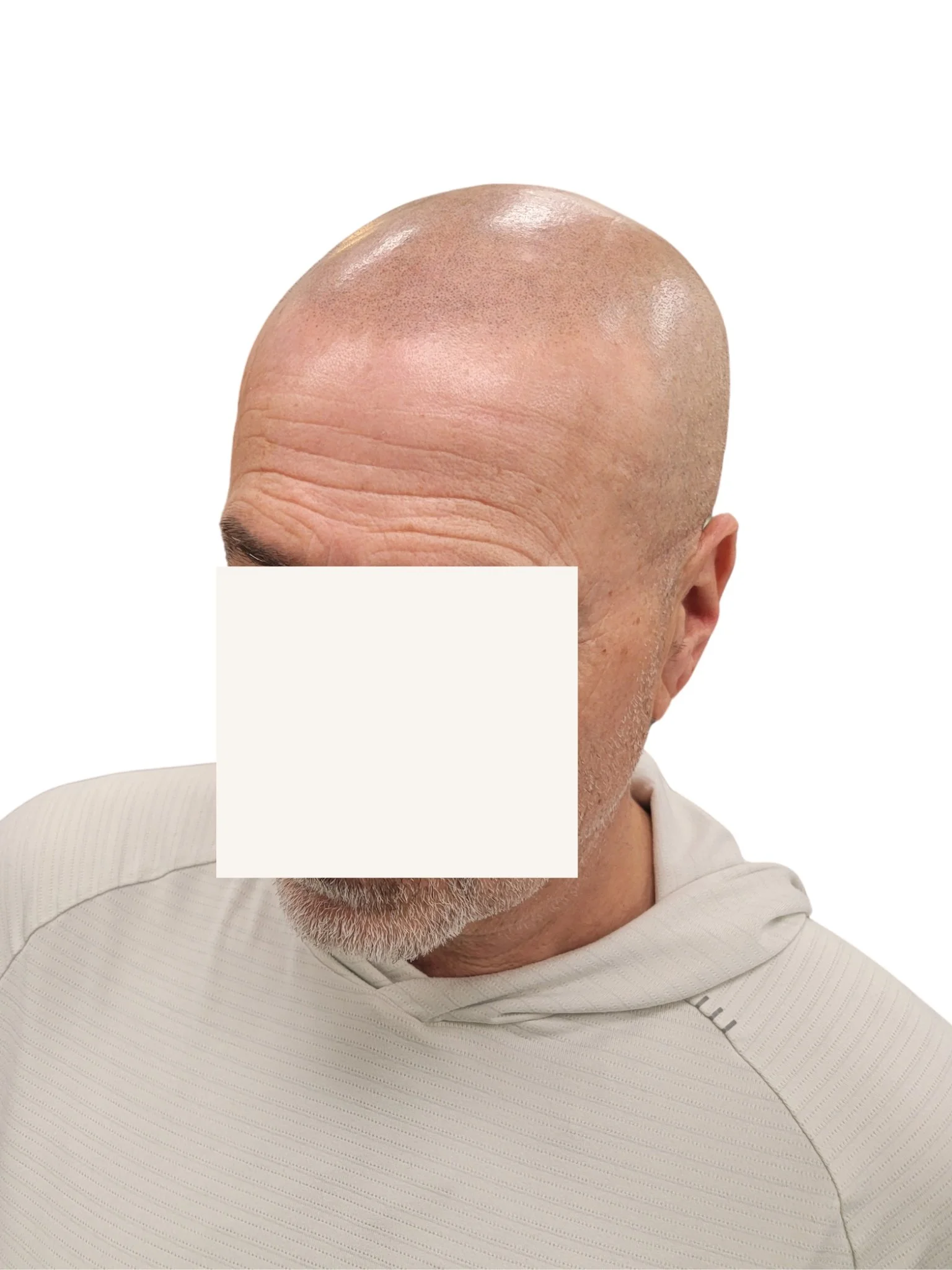 Close-up of a person's forehead with visible skin texture, hair, and some brown spots.