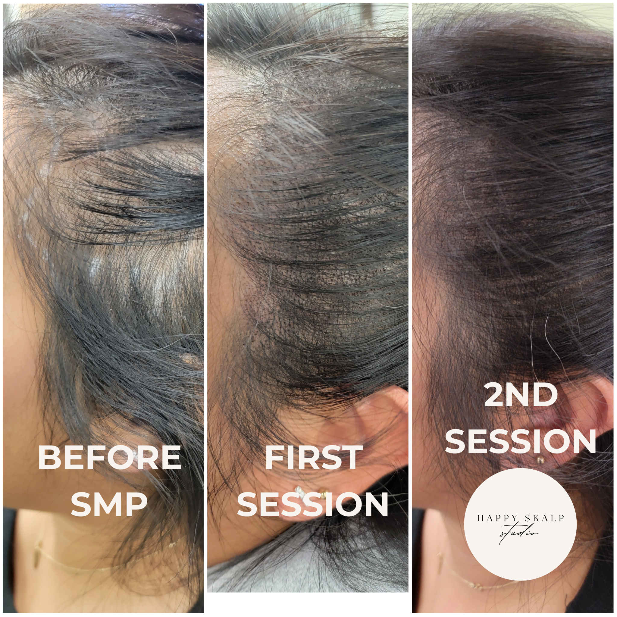 Progress photos showing scalp hair restoration before and after two treatment sessions at Happy Scalp Studio, with images labeled 'Before SMP,' 'First Session,' and '2nd Session.'