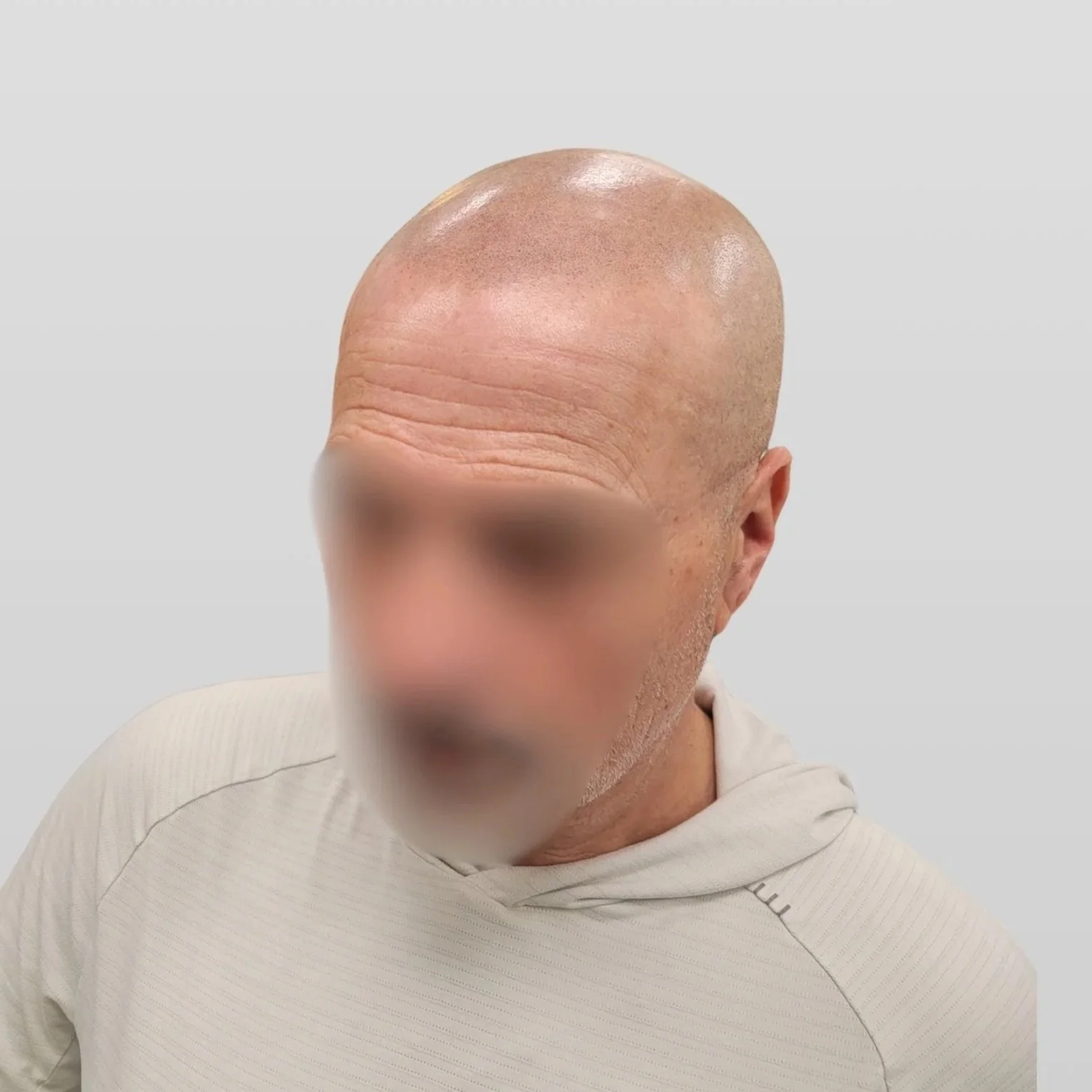 Close-up of a person's forehead with visible skin texture, hair, and some brown spots.