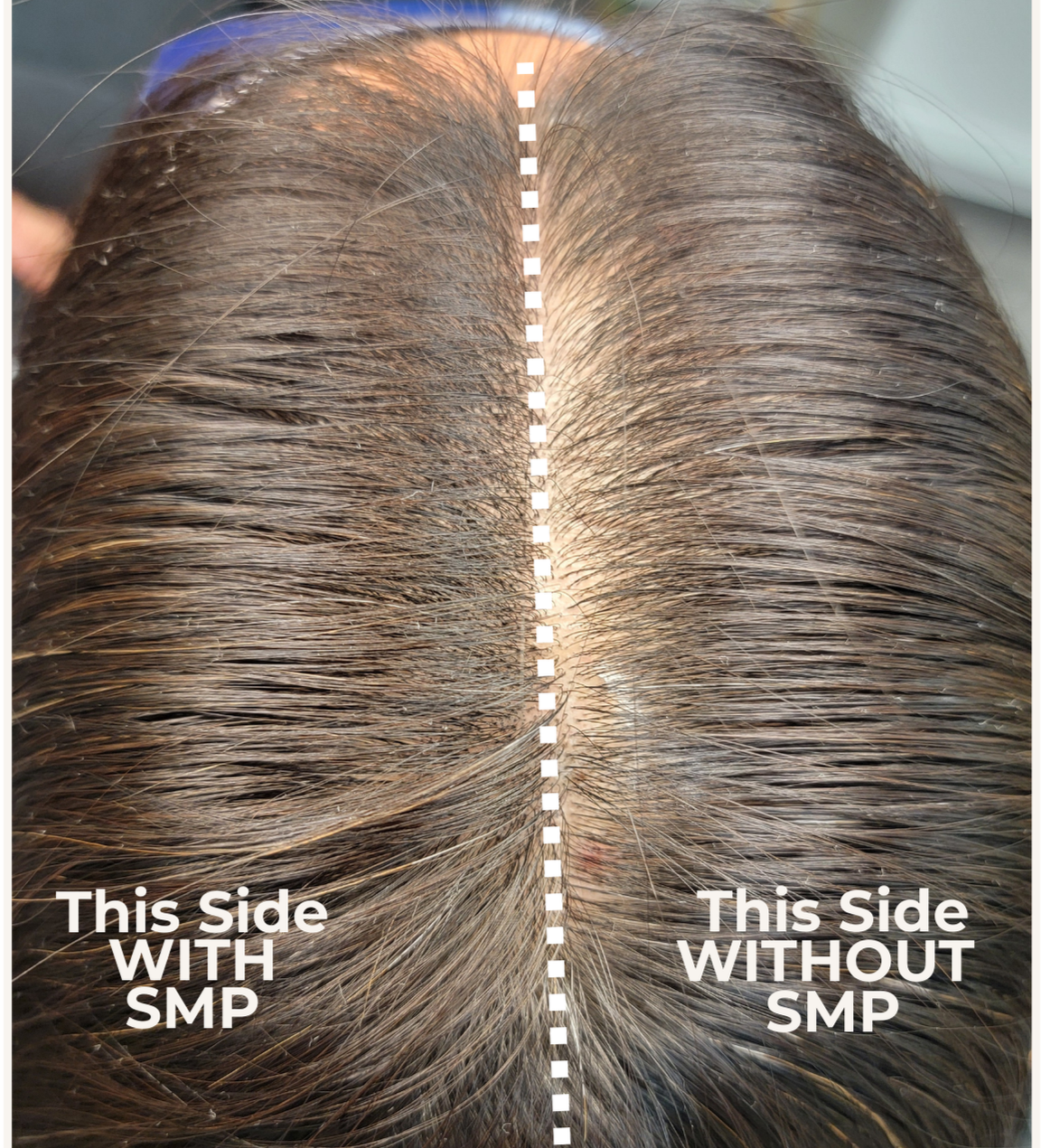 Top view of a person's scalp showing the difference in hair health with and without scalp micro pigmentation, divided by a dotted line, with labels 'This Side WITH SMP' on the left and 'This Side WITHOUT SMP' on the right.