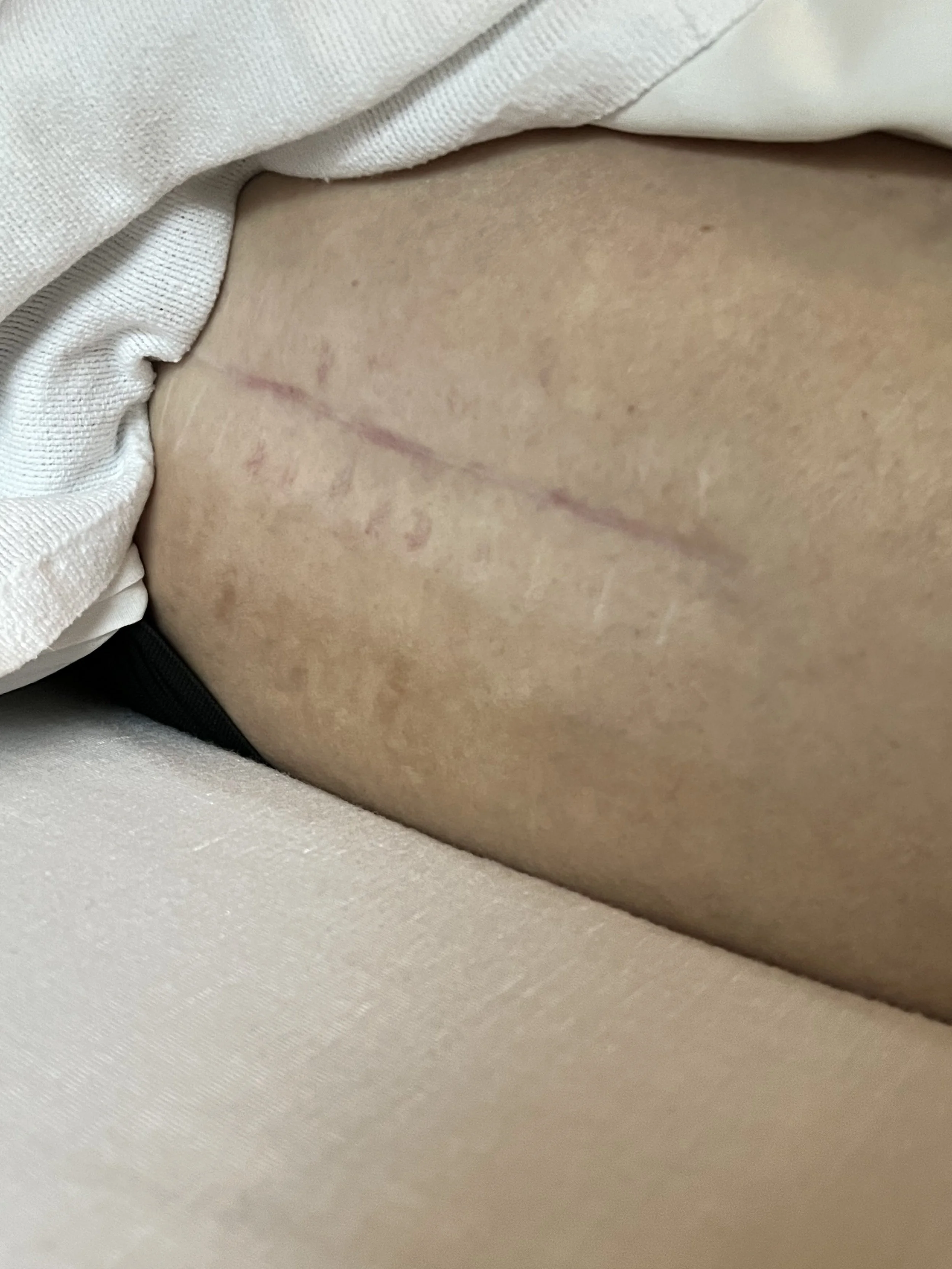 Scar tissue from September 10th