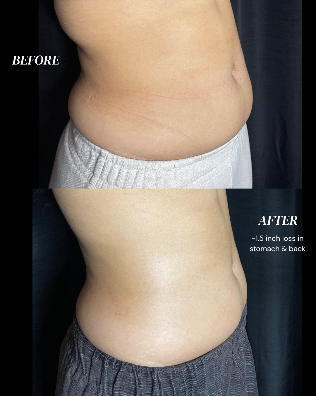 Body Yadi Tummy (1 Session)